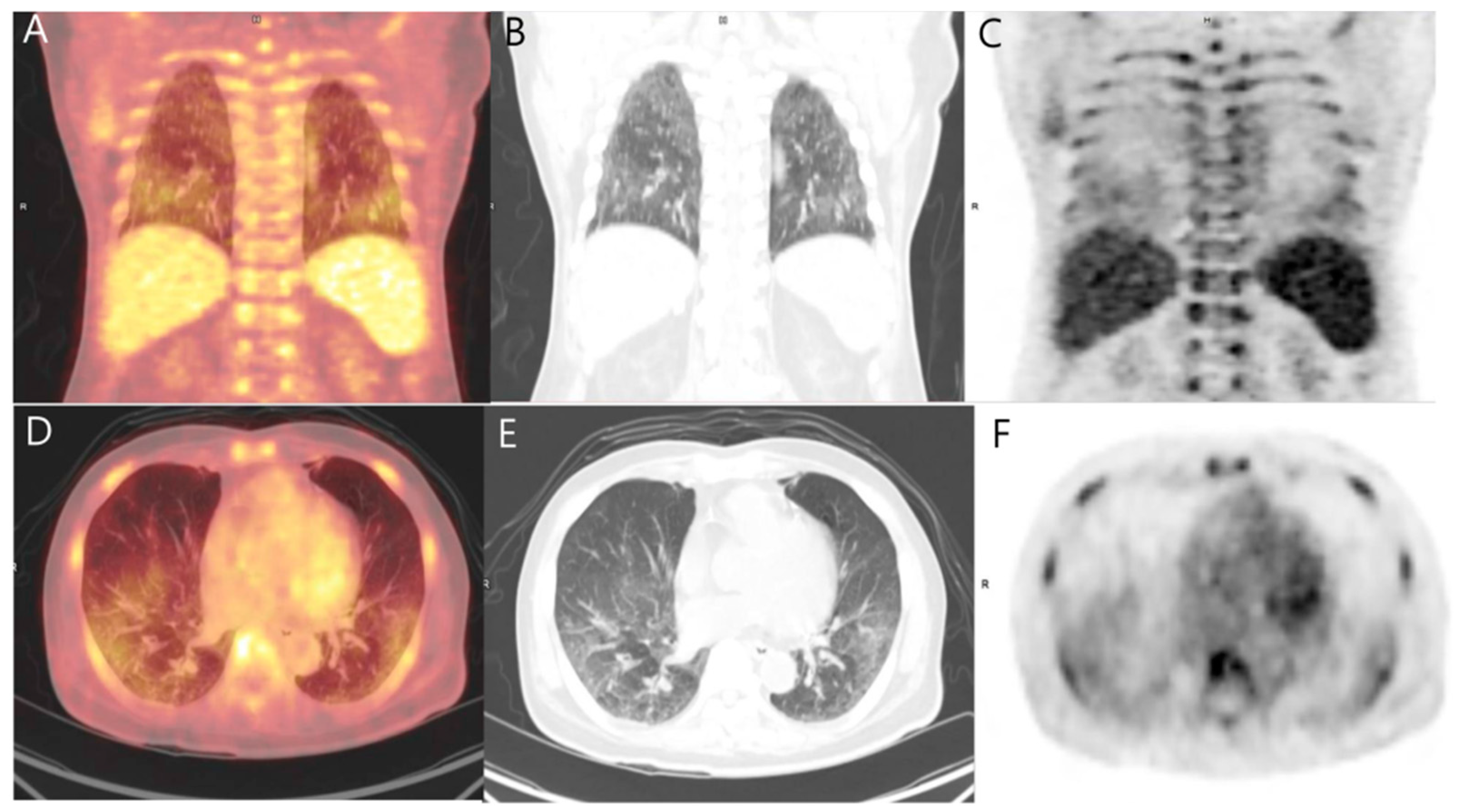 Diagnostics Free FullText Metastatic Pulmonary Calcification