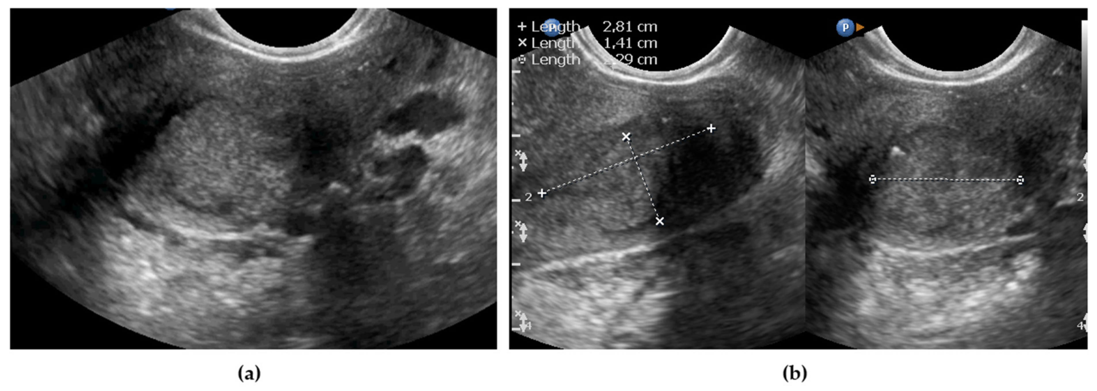 Uterine Cancer Ultrasound Images uterine-cancer-ultrasound-images