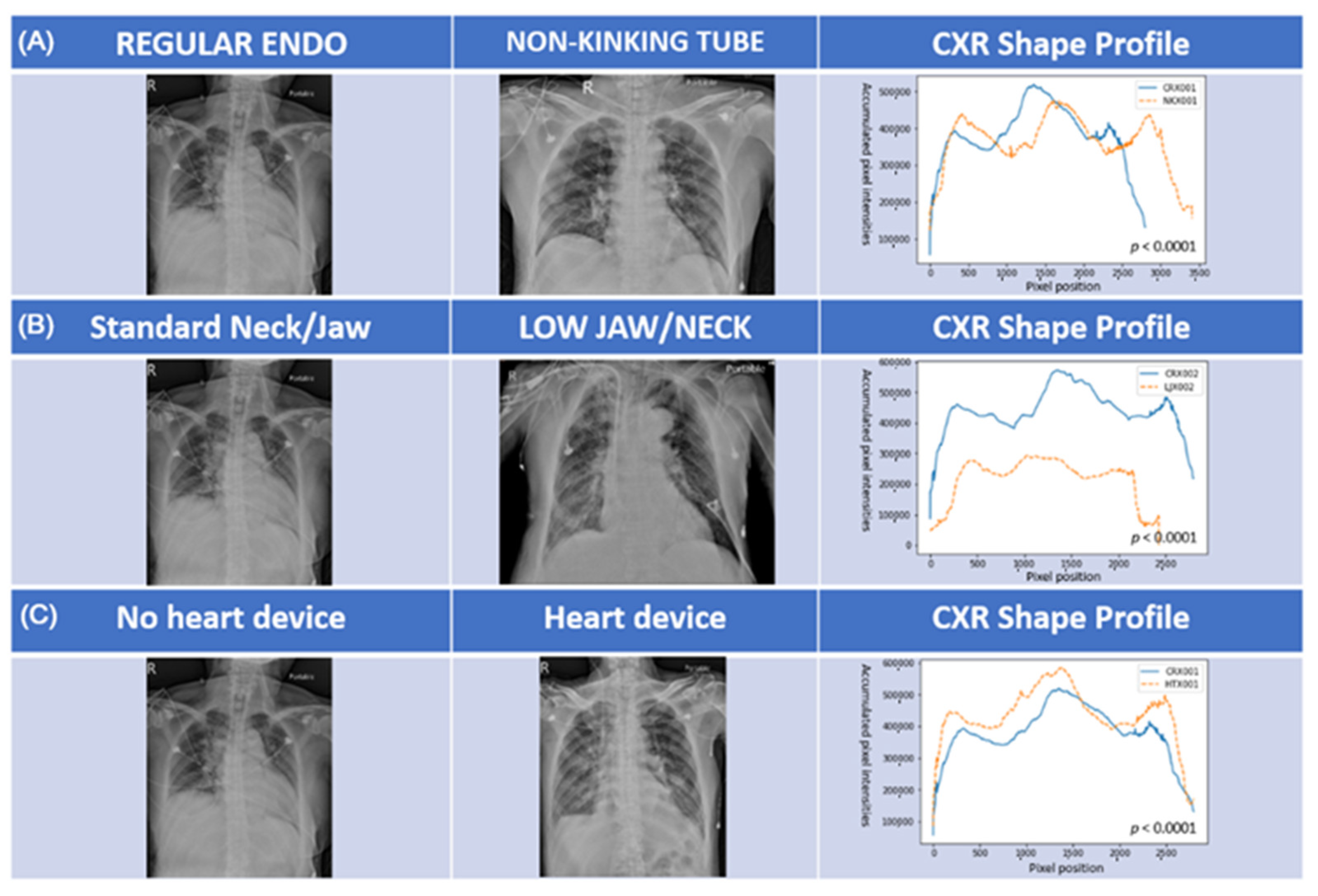 Endotracheal Tube Placement X Ray