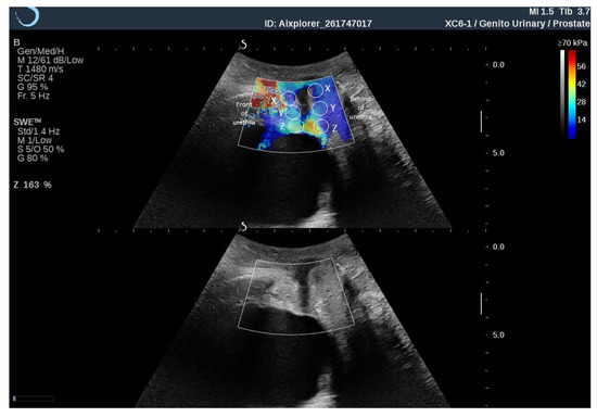 prostate fibrosis mi az