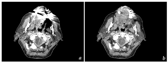 裁断済 臨床頭頸部癌学 = Clinical Head and Neck On Detectability of Head and Neck Cancer via New Computed