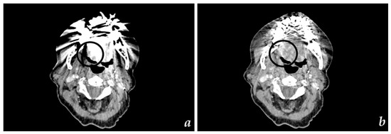 Detectability of Head and Neck Cancer via New Computed