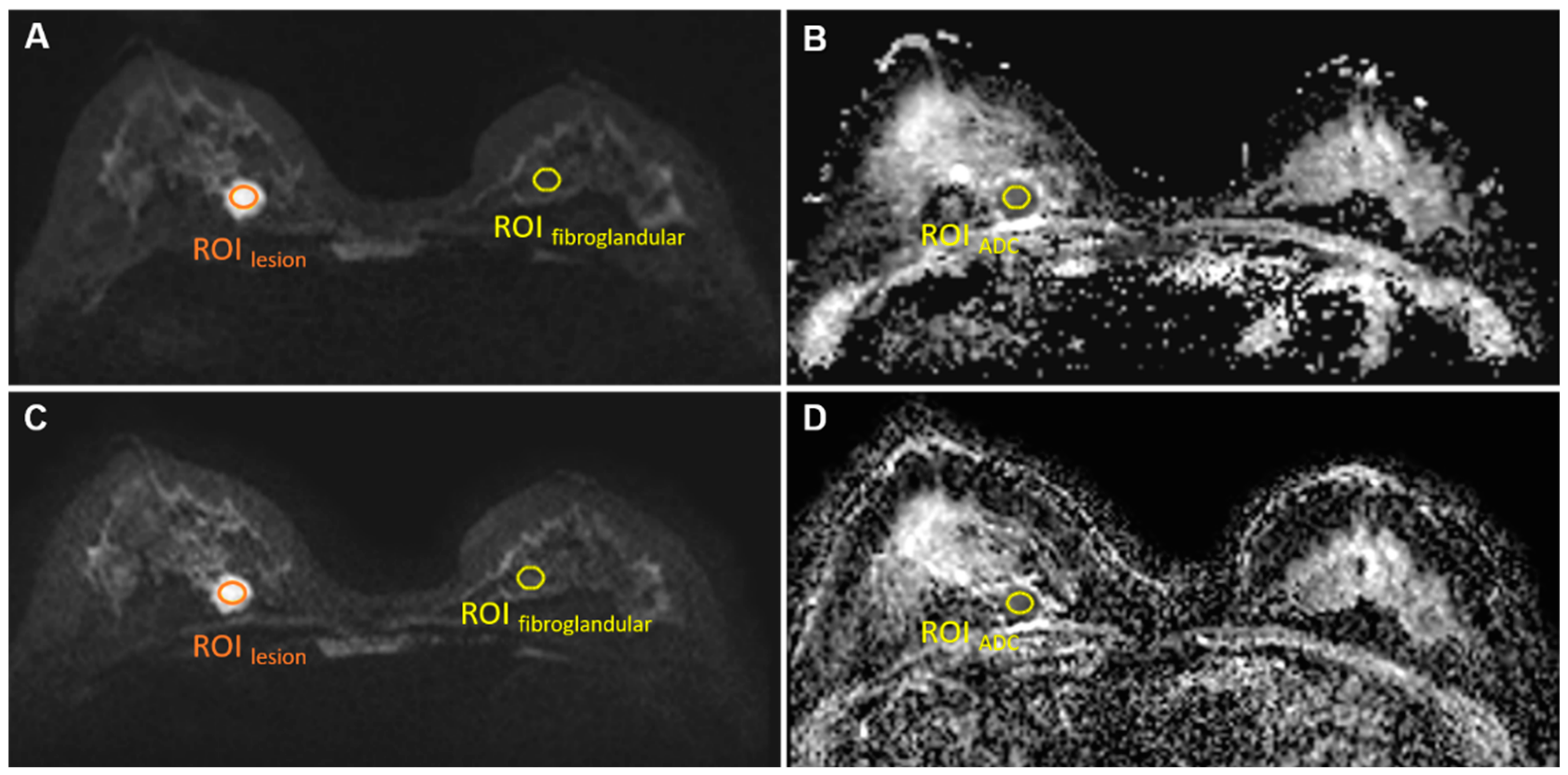 Comparison of SI with b value of 1000 s/mm2 in malignant and benign