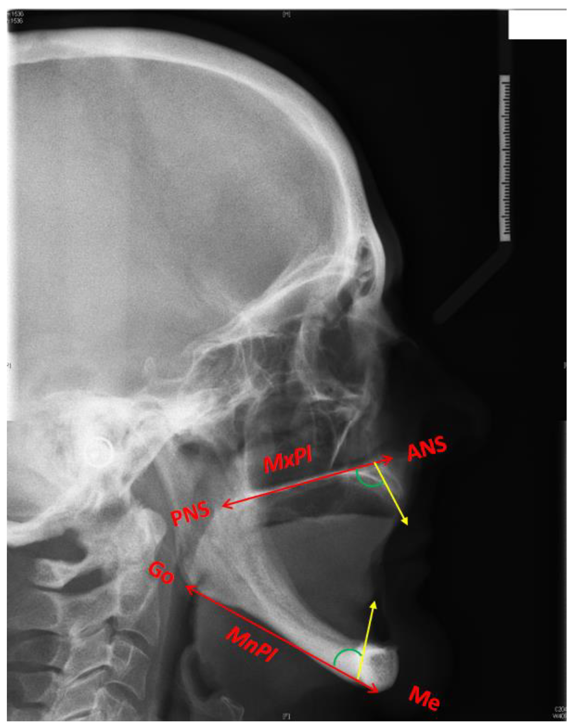 Diagnostics Free FullText Analysis of Residual Ridge Morphology in