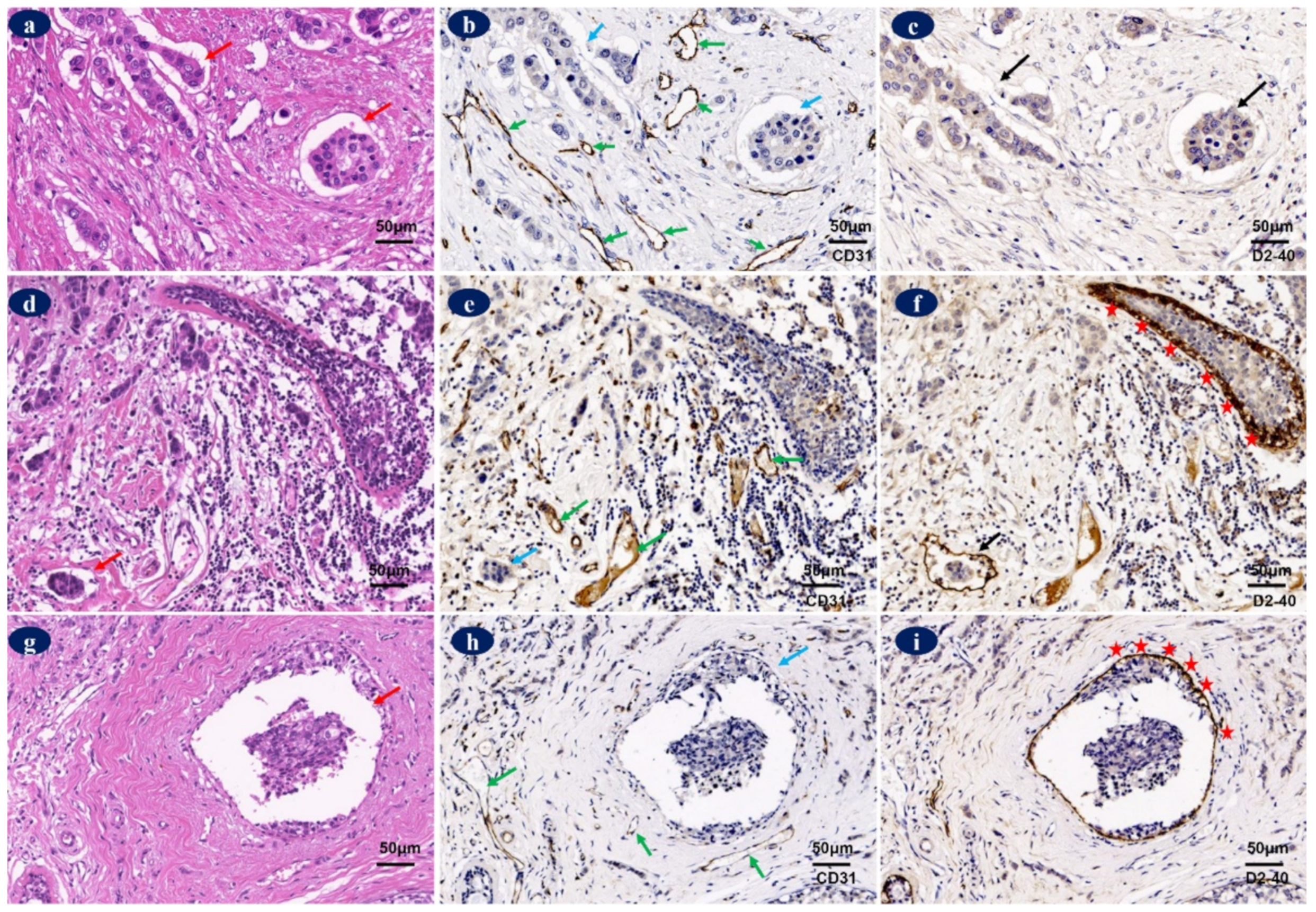 Lymphatic Phlegm 