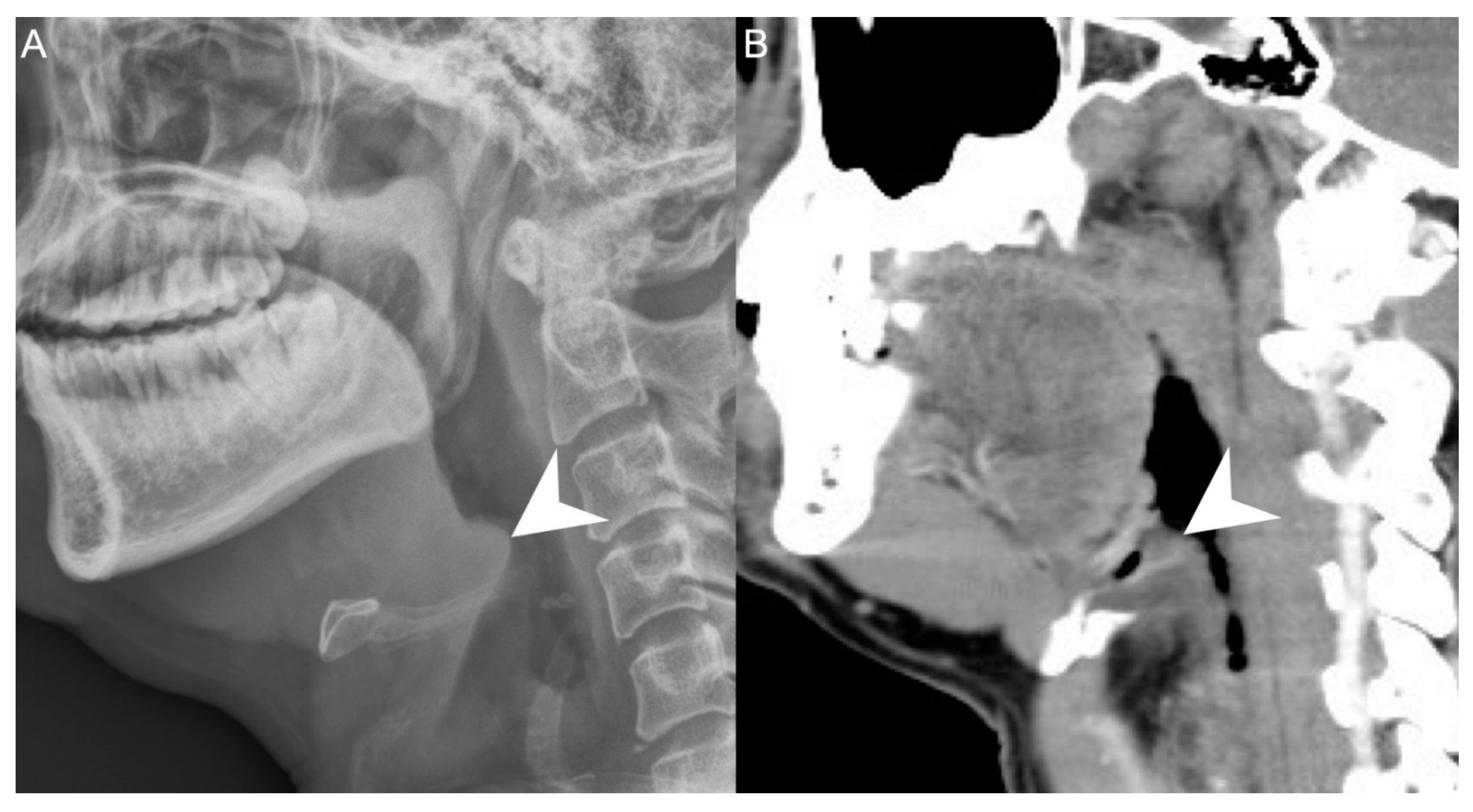 Peritonsillar Abscess X Ray