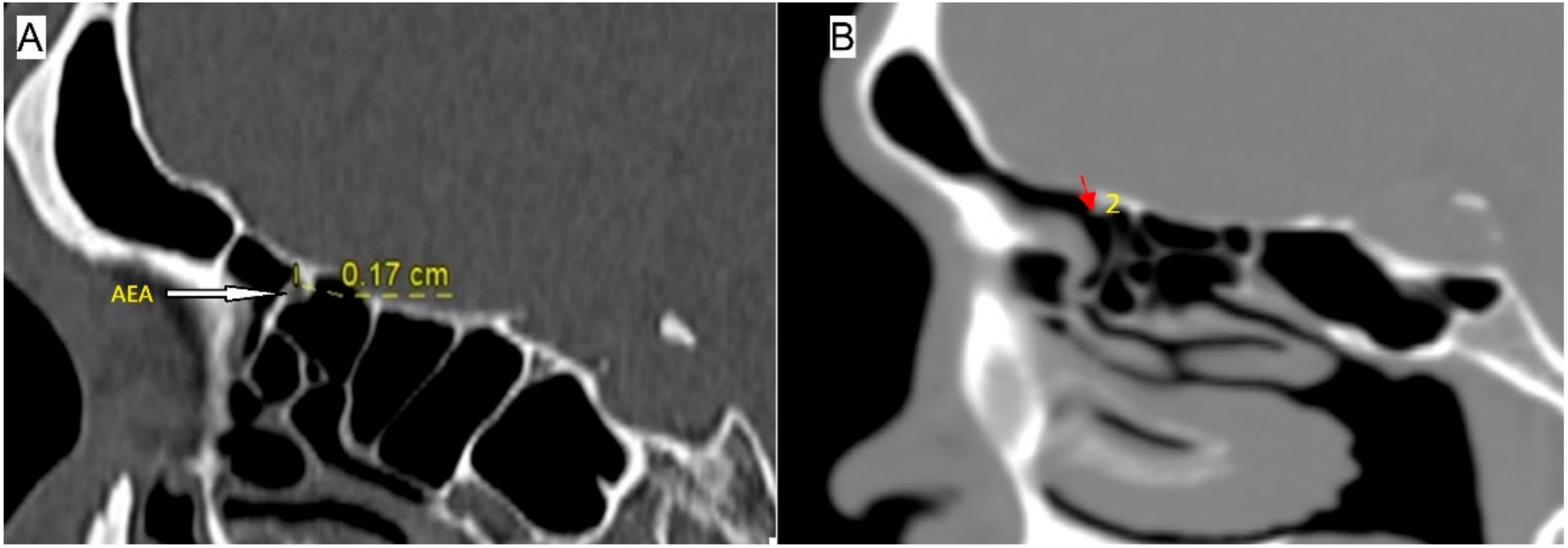 Anterior Ethmoidal Foramen