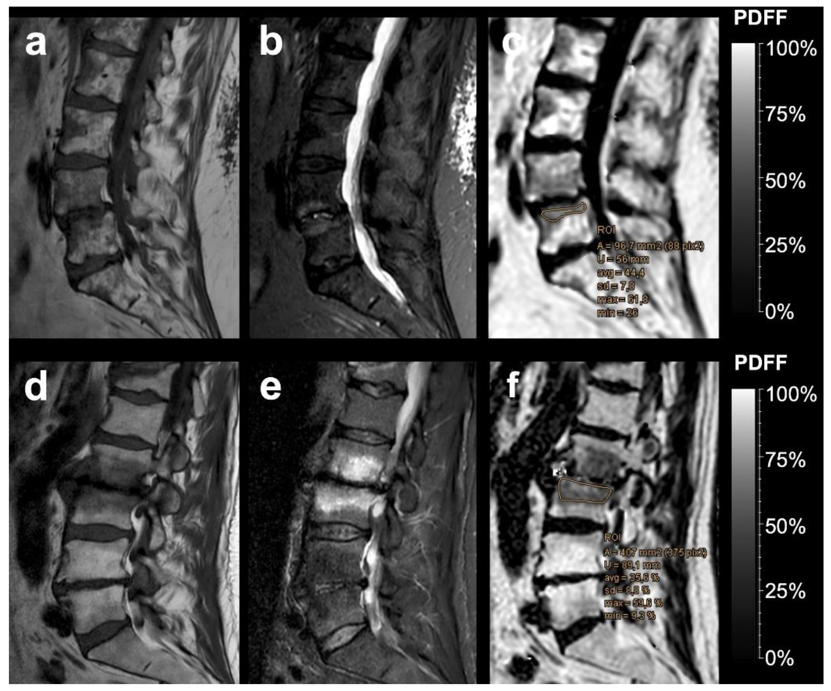 prostatitis vagy osteochondrosis