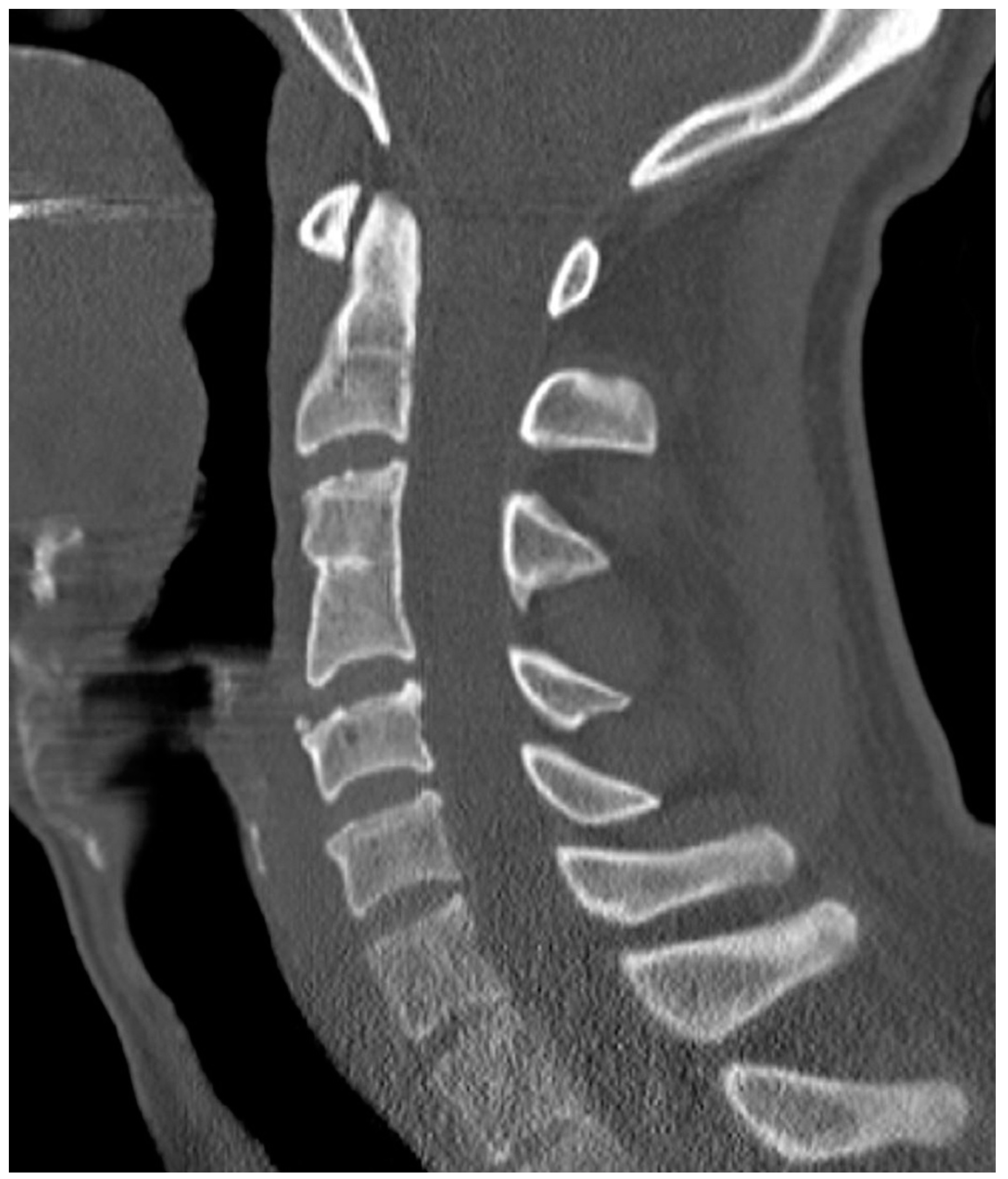 Diagnostics Free FullText Are Congenital Cervical Block Vertebrae