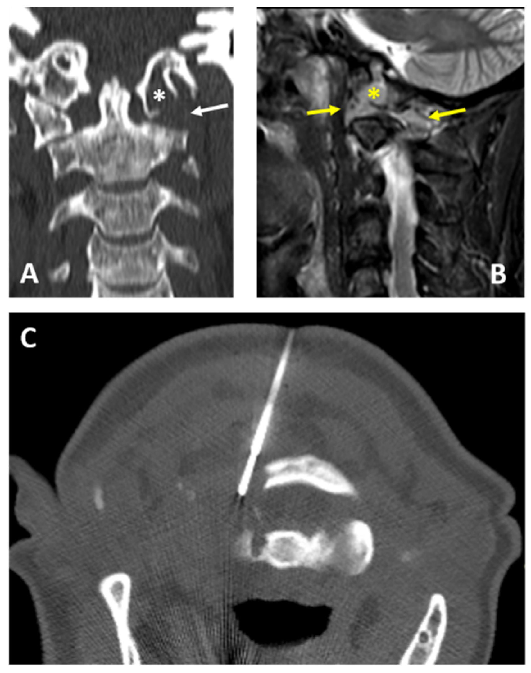 Overcoming CT-to-Body Divergence to Biopsy, Definitively Diagnose and Mark  a Subcentimeter Lesion