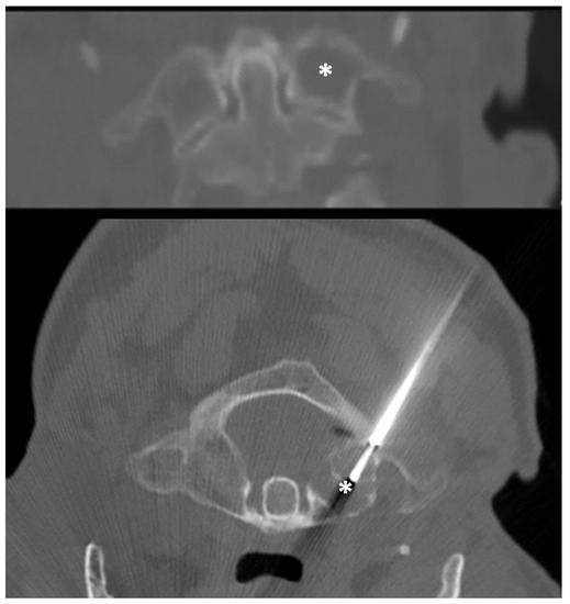 Percutaneous CT-Guided Biopsy of the Craniovertebral