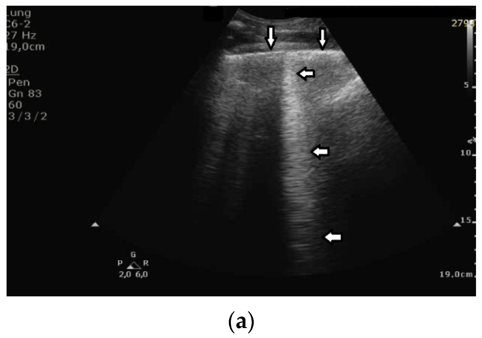 Accuracy of abdominal ultrasound for the diagnosis of pneumoperitoneum in  patients with acute abdominal pain: a pilot study | The Ultrasound Journal  | Full Text