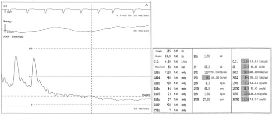 Chronic Thromboembolic Pulmonary Hypertension: An Update