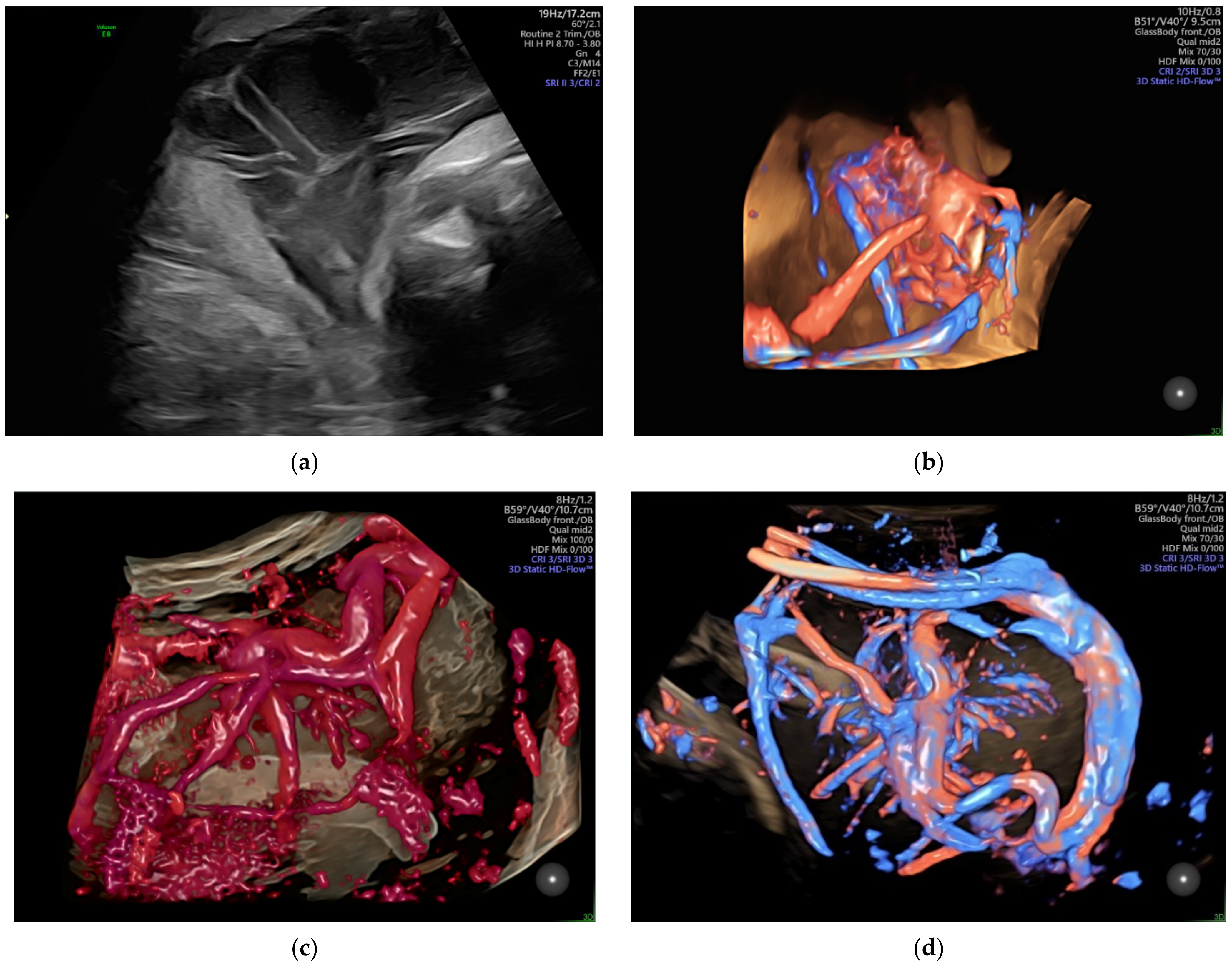 The average radial artery blood flow velocity (vrad.art.mean