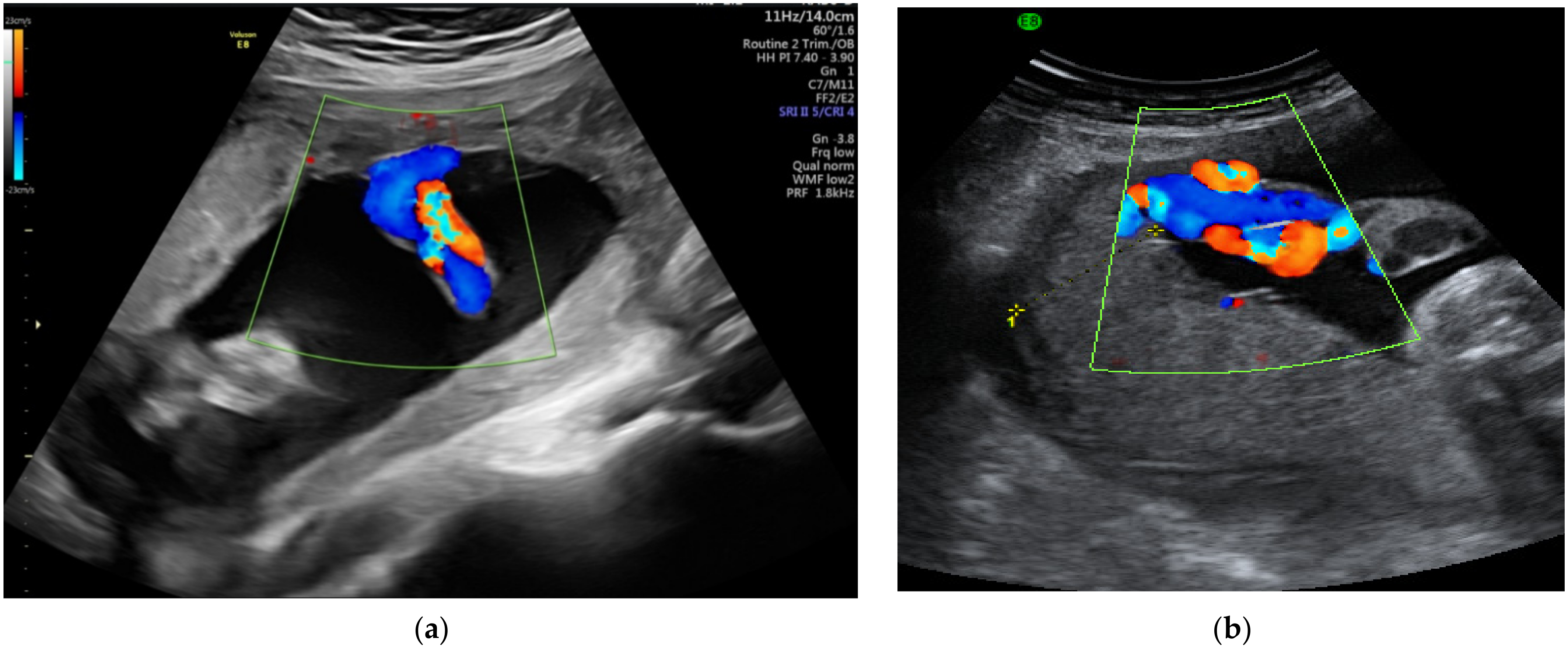 Umbilical Cord Around Neck Ultrasound