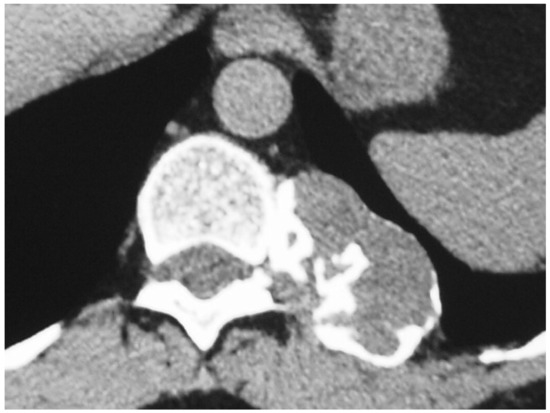 Grade 1 and 2 Chondrosarcomas of the Chest Wall: CT Imaging Features ...