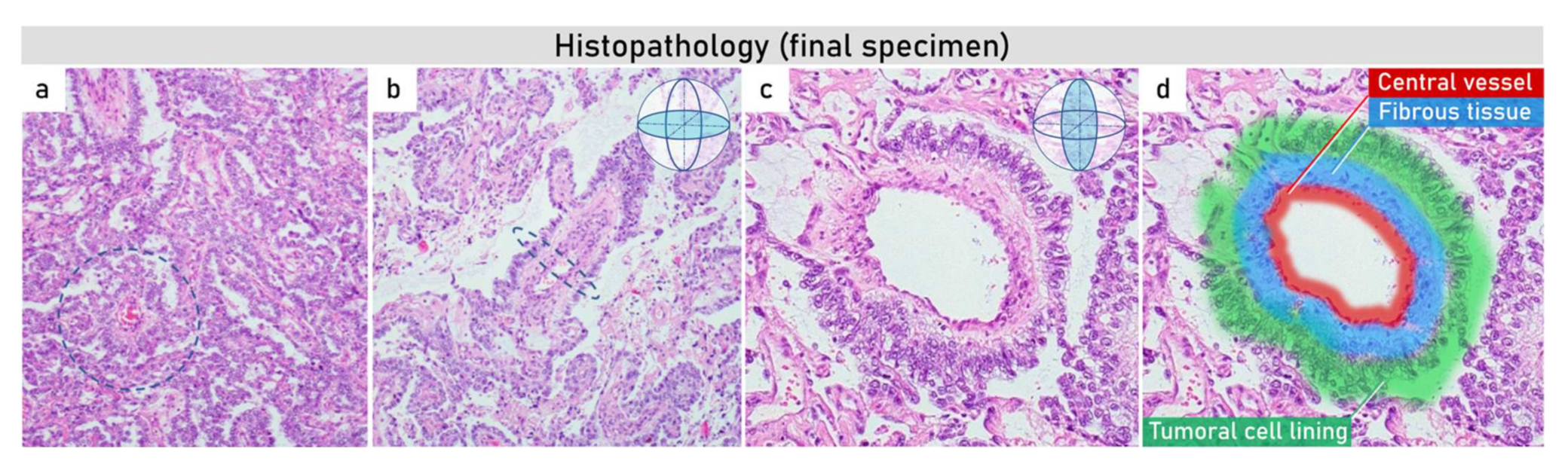 Rainy Gaseous South Diagnostics | Free Full-Text | Yolk Sac Tumor of the Omentum: A Case Report and Literature Review | HTML Rainy Gaseous South Diagnostics | Free Full-Text | Yolk Sac Tumor of the Omentum: A Case Report and Literature Review | HTML