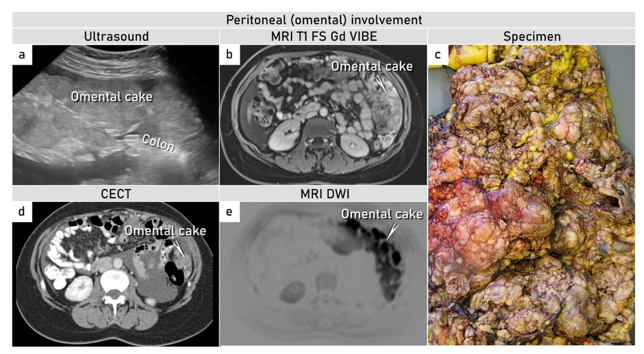 Rainy Gaseous South Diagnostics | Free Full-Text | Yolk Sac Tumor of the Omentum: A Case Report and Literature Review | HTML Rainy Gaseous South Diagnostics | Free Full-Text | Yolk Sac Tumor of the Omentum: A Case Report and Literature Review | HTML