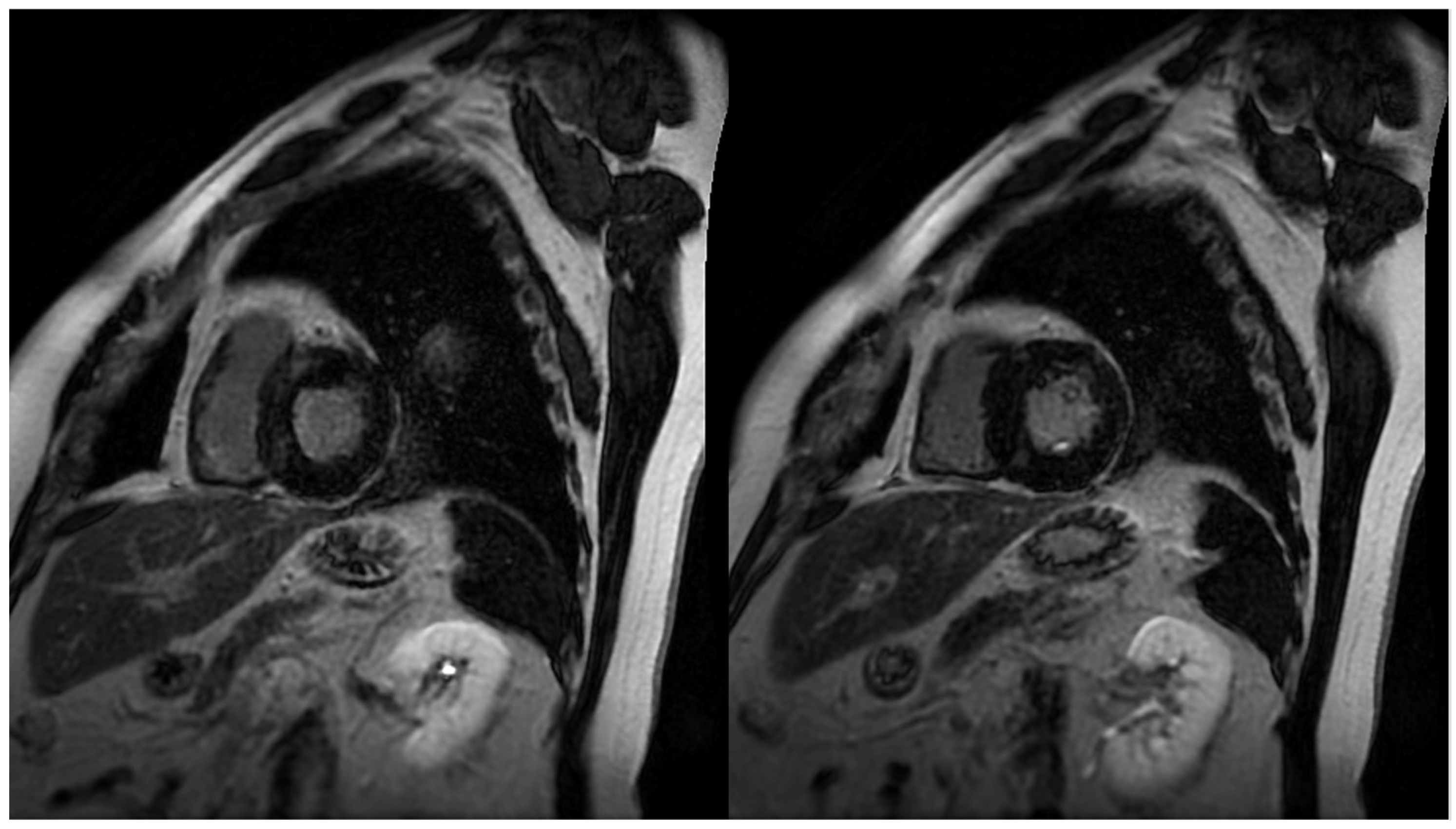 Diagnostics | Full-Text | The Role of Magnetic Resonance Imaging in Evaluation of Hypertrophic Cardiomyopathy