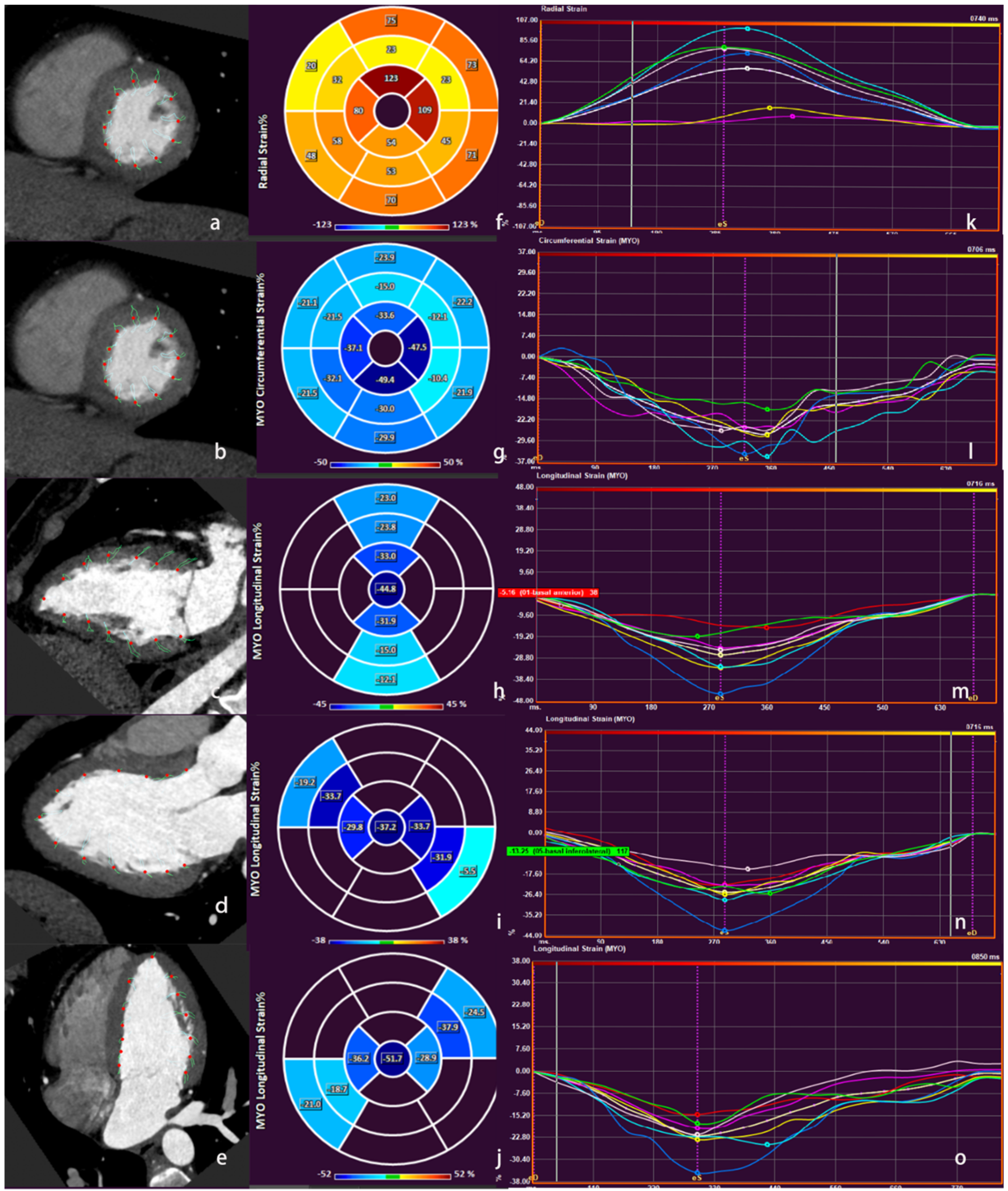 Global longitudinal strain is a more reproducible measure of left