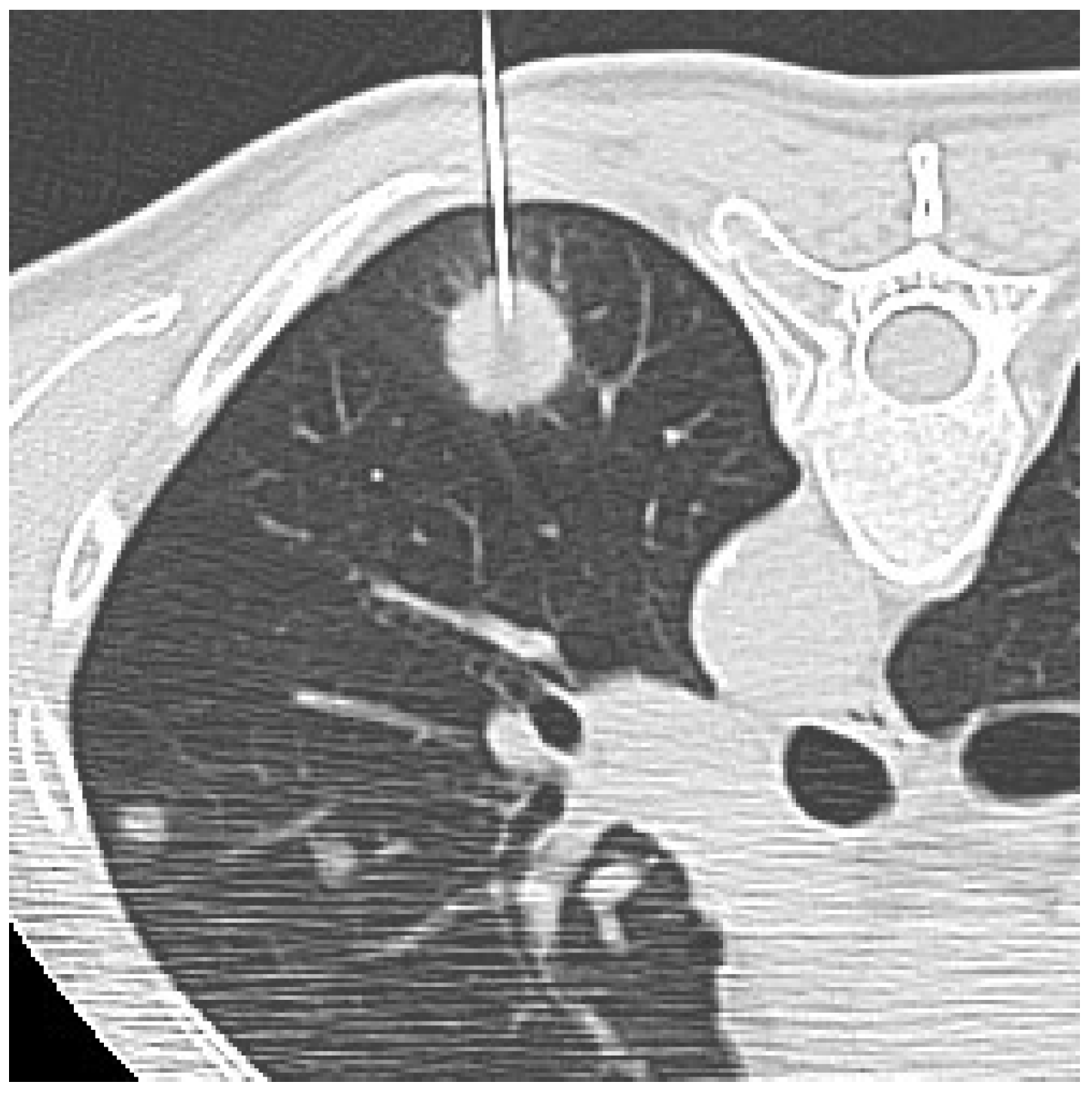 Diagnostics Free Full-Text CT-Guided Transthoracic Biopsy of Pulmonary Lesions Diagnostic versus Nondiagnostic Results