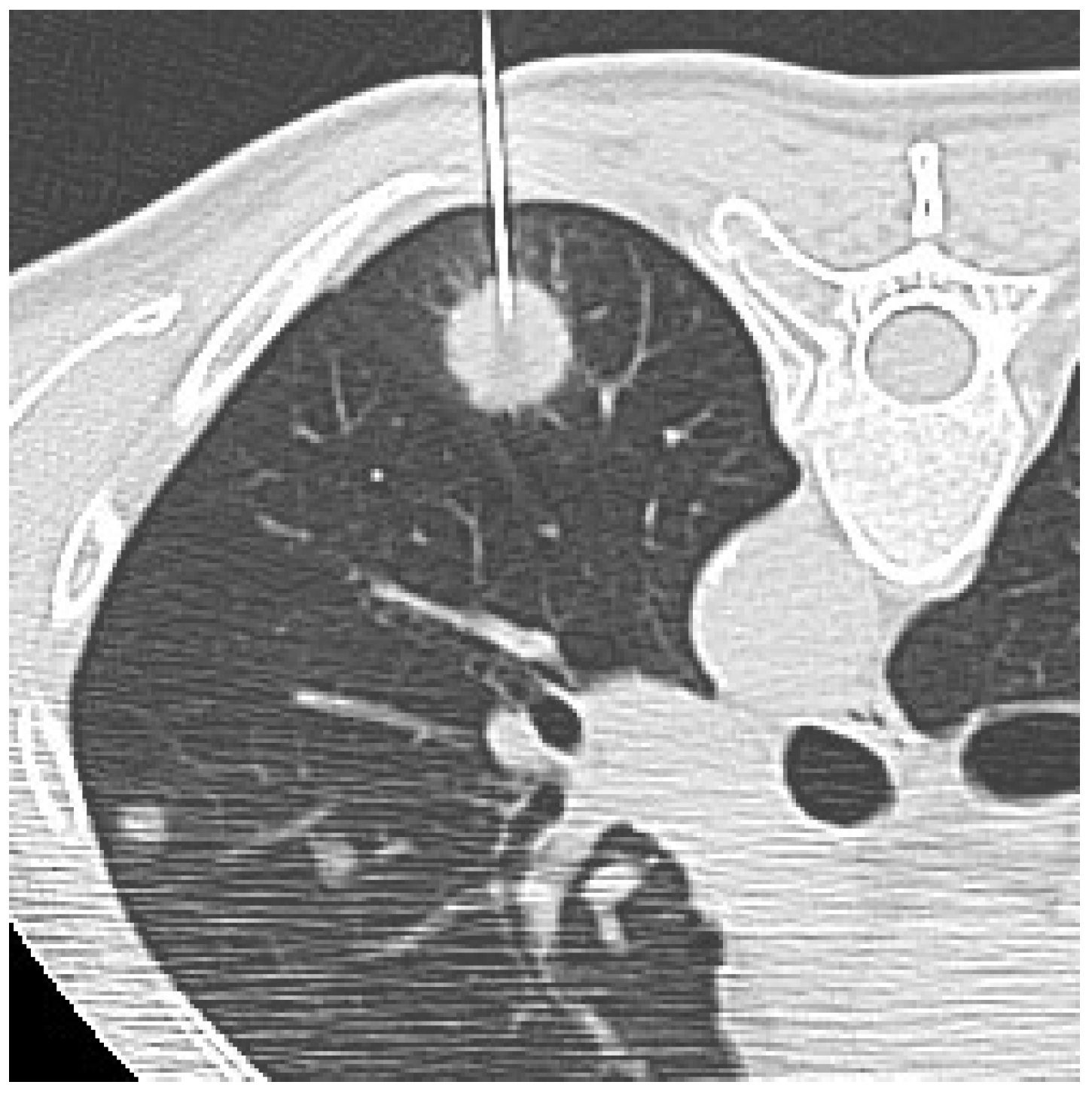 Diagnostics Free FullText CTGuided Transthoracic Biopsy of