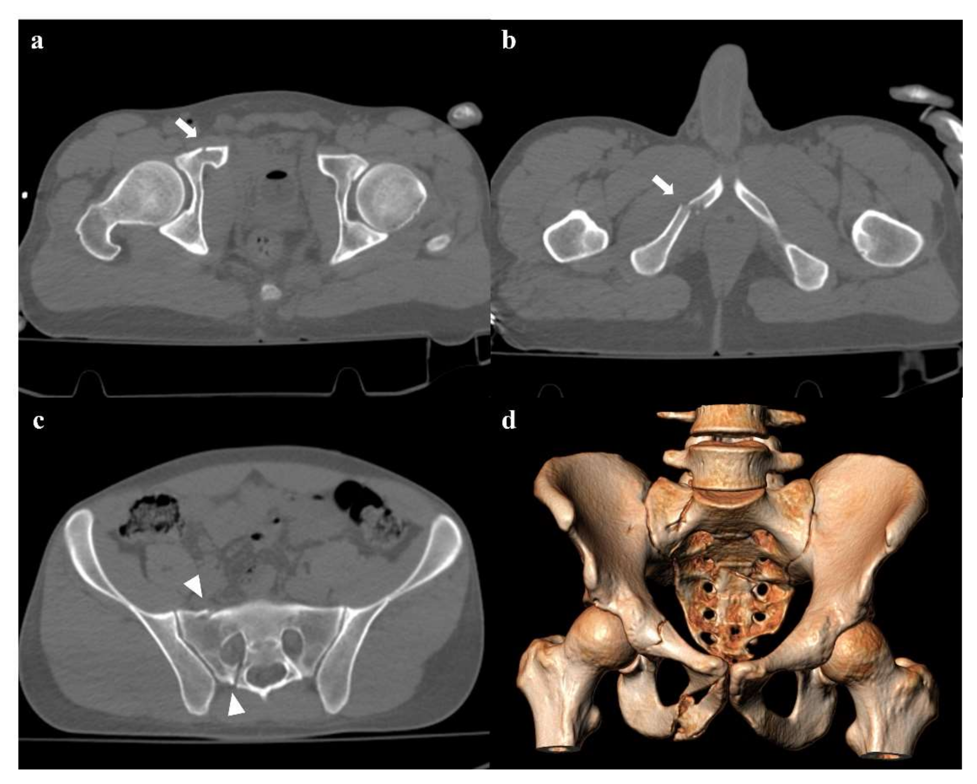 Fracture of Pelvis Without Disruption of Pelvic Ring