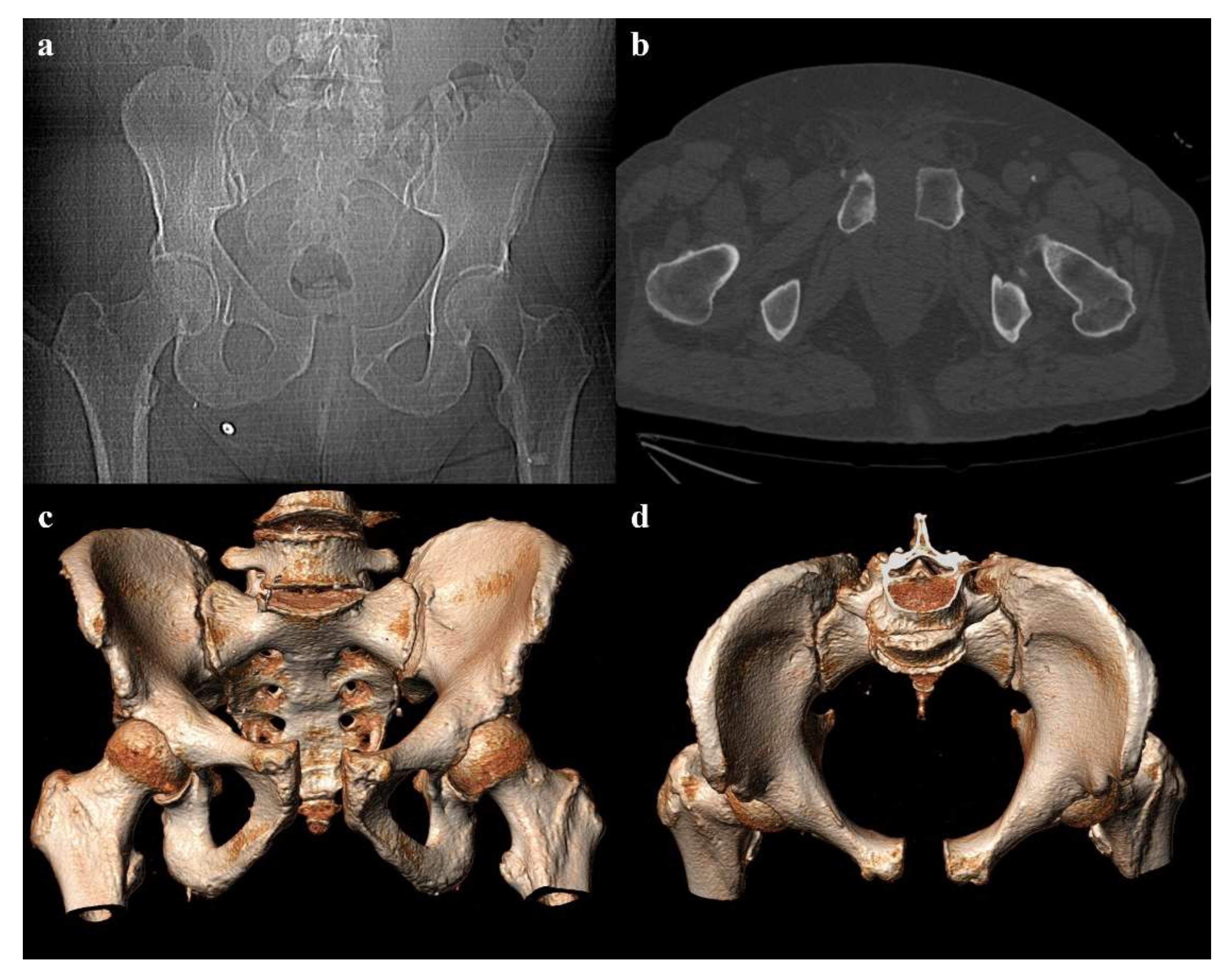 Sacral Fractures: The Forgotten Bone | PDF | Pelvis | Back Pain