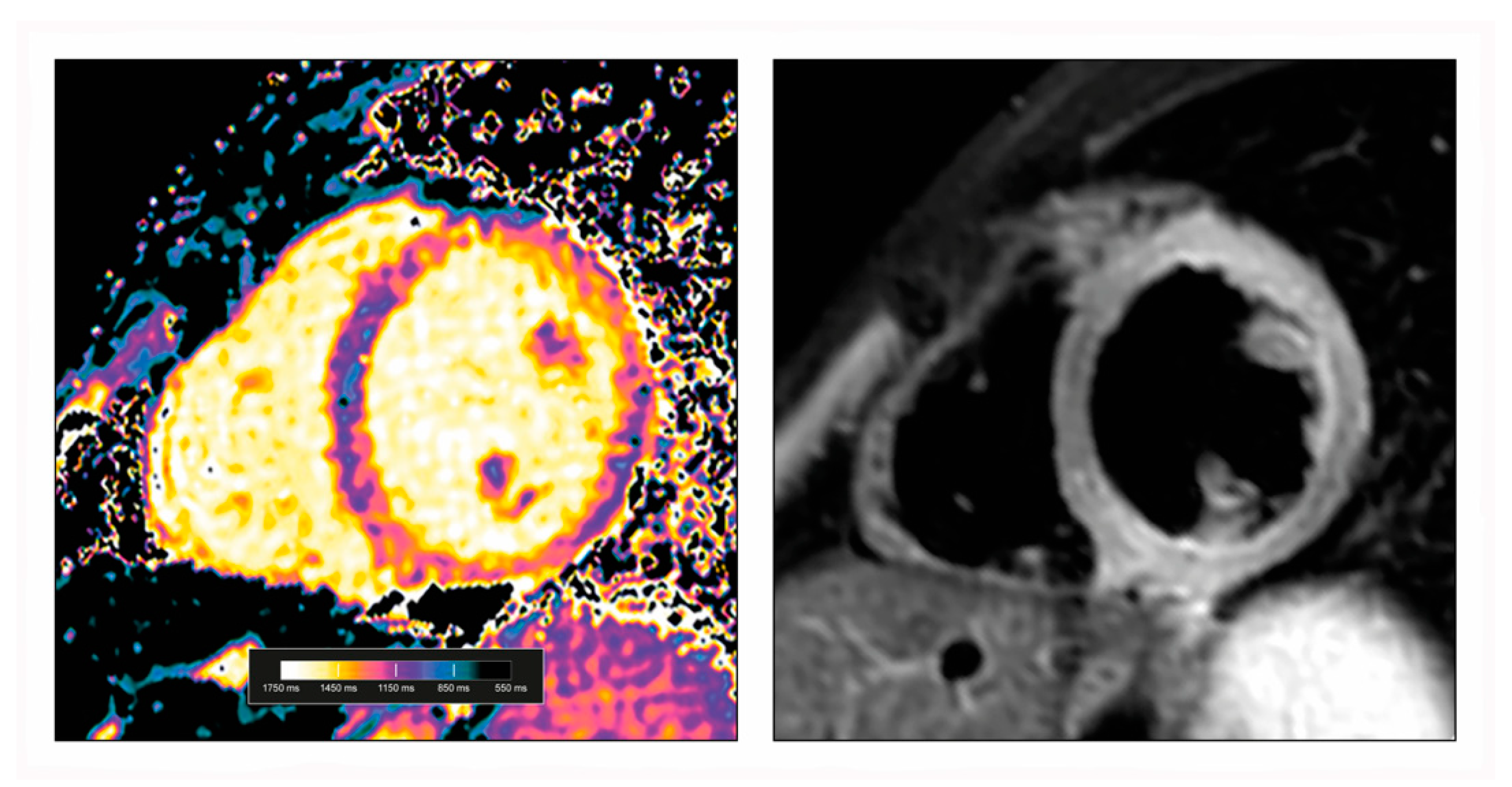 T2 Relaxation Times at Cardiac MRI in Healthy Adults: A Systematic