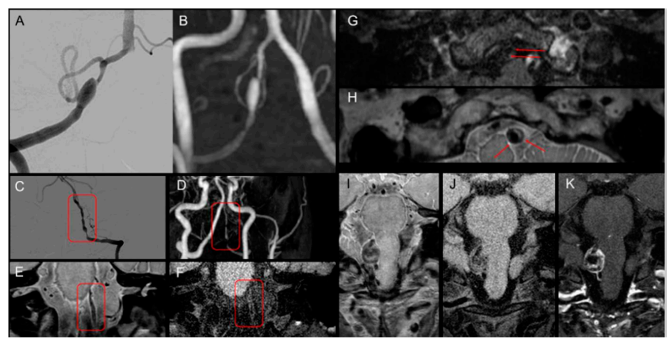 Diagnostics Free FullText Diagnostic Performance of HighResolution Vessel Wall