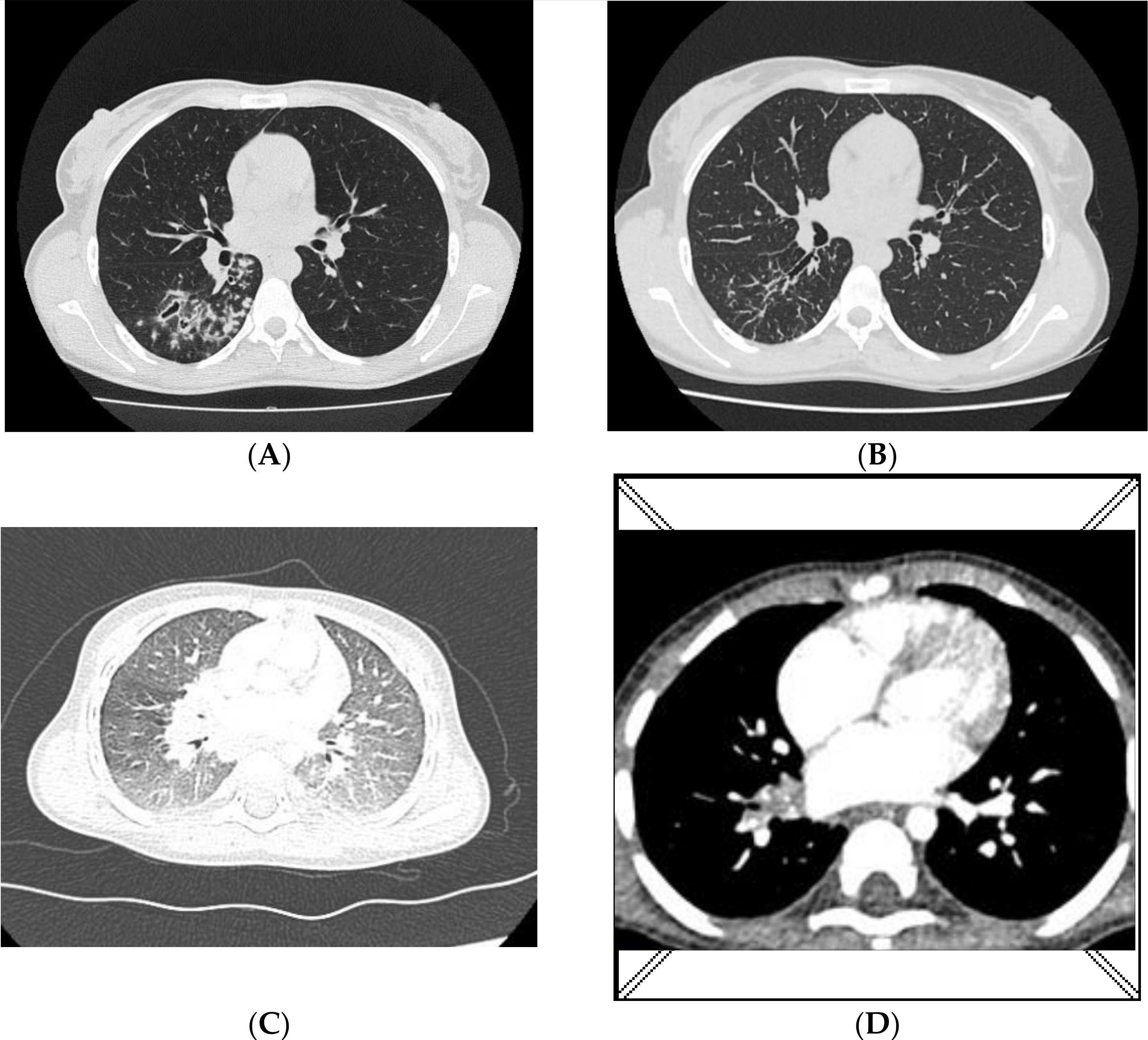 XDR-TB Transmitted from Mother to 10-Month-Old Infant XDR-TB Transmitted from Mother to 10-Month-Old Infant