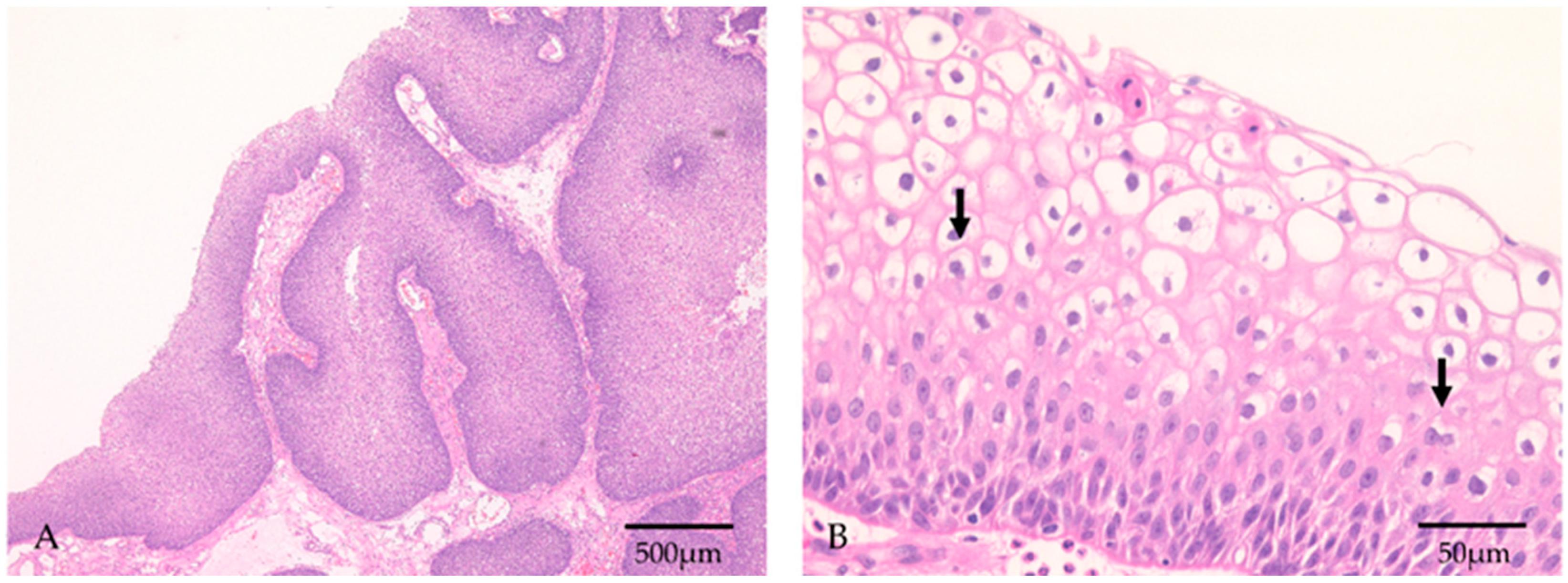 Diagnostics Free Full-Text Clinicopathologic Analysis of Sinonasal Inverted Papilloma, with Focus on Human Papillomavirus Infection Status Sex Pic Hd