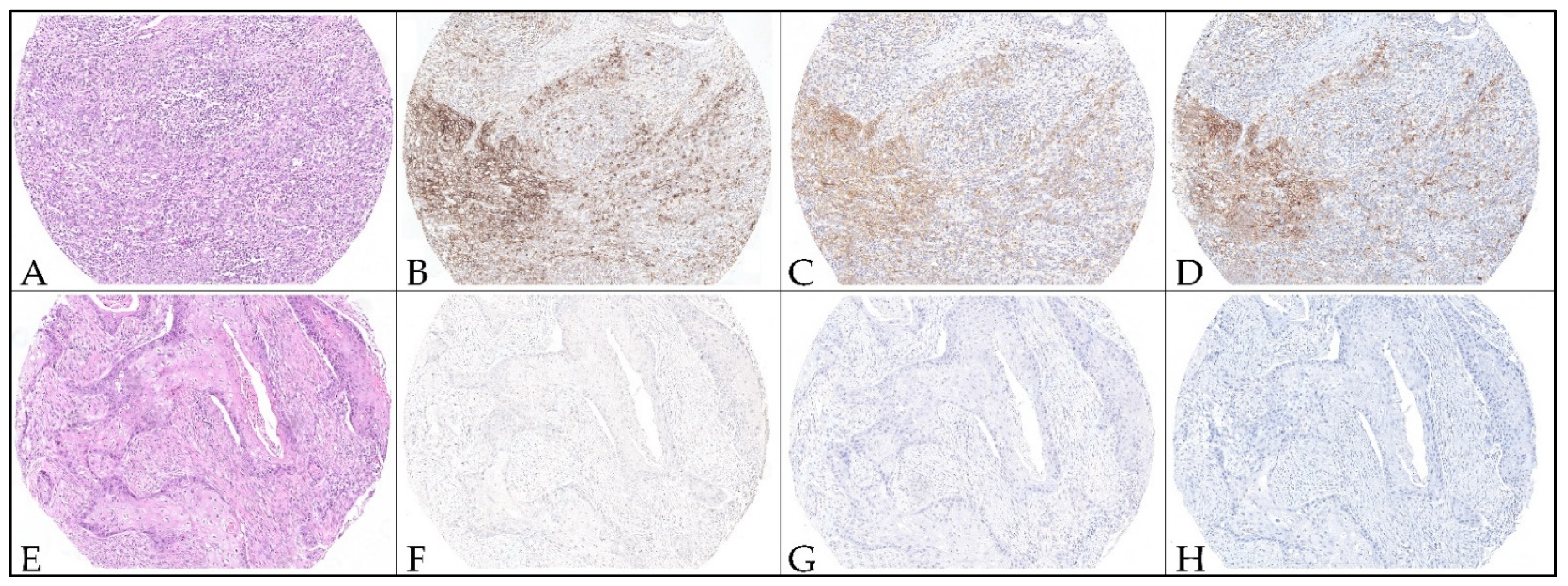 Concordance between Three PD-L1 Immunohistochemical Assays