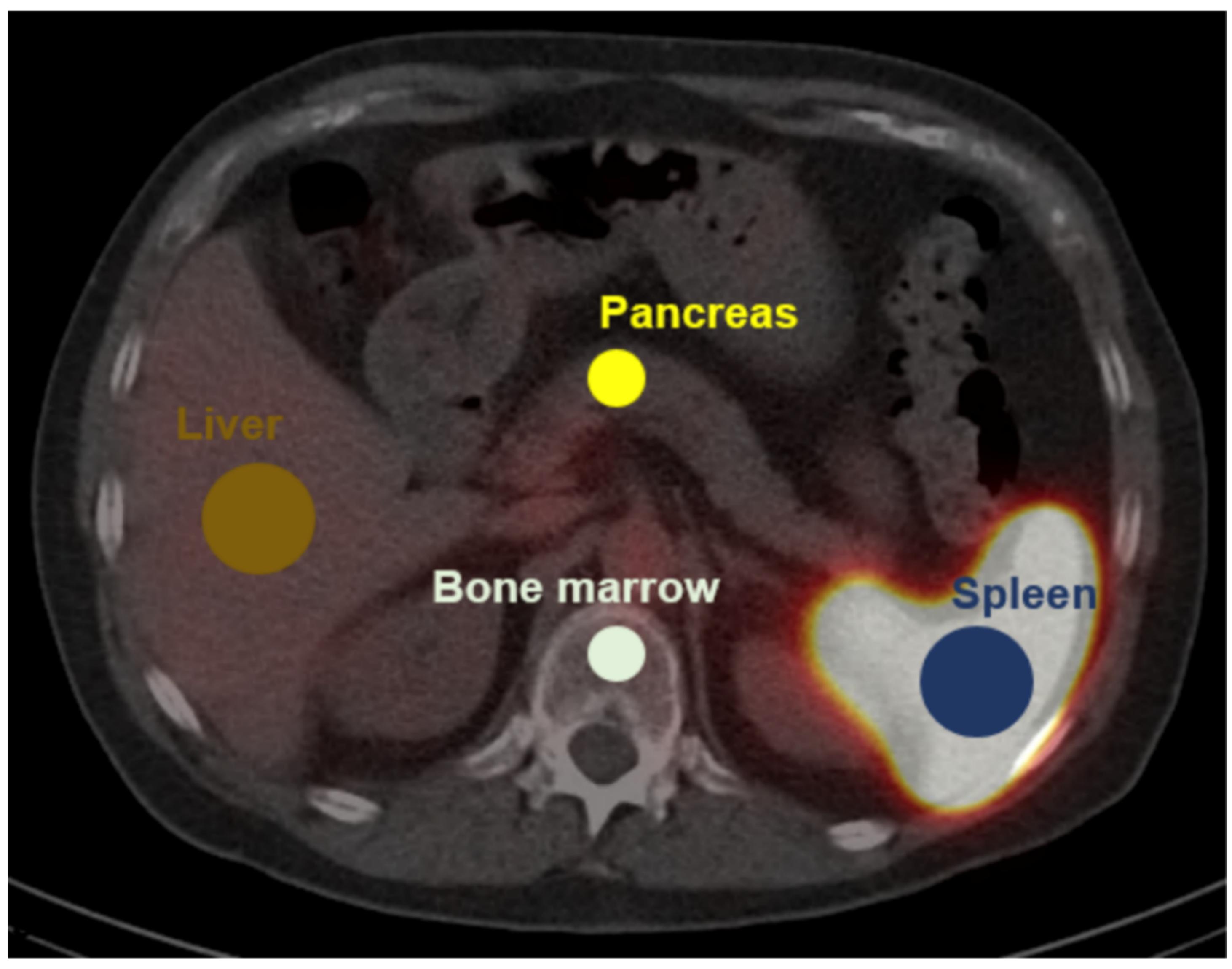 Detection of Splenic Tissue Using 99mTc-Labelled Denatured