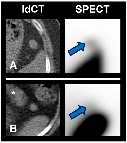 【CRIME】NUCLER BLOOD　Sonosheet Detection of Splenic Tissue Using 99mTc-Labelled Denatured