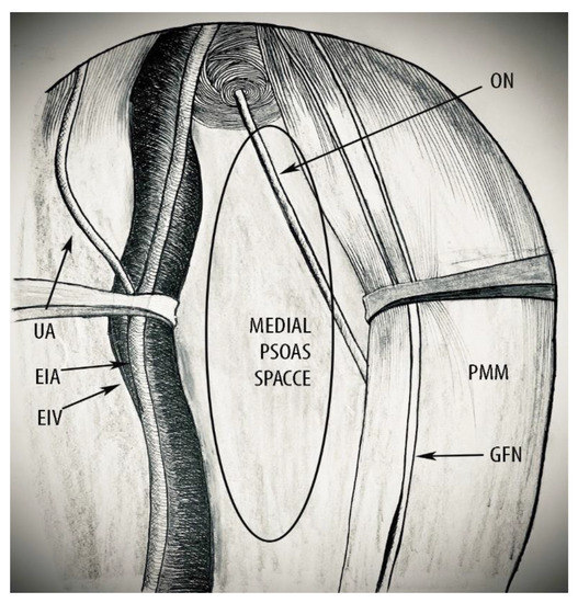 Pelvic Sidewall Anatomy in Gynecologic Oncology—New Insights into a ...