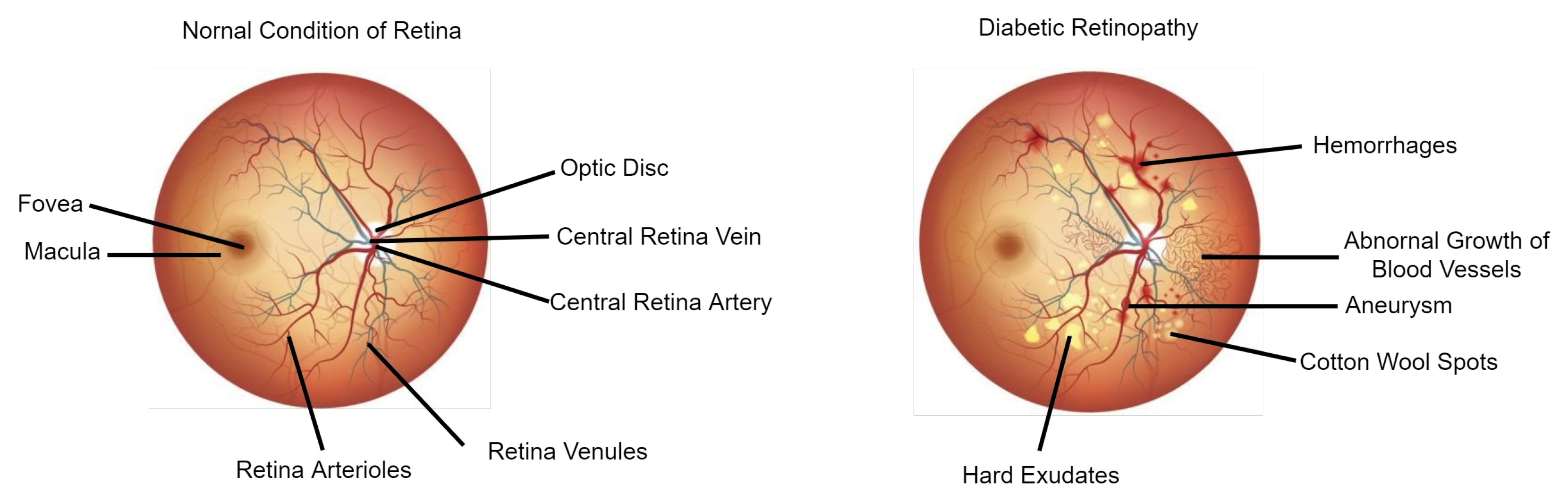 diabetic retinopathy research paper 2022