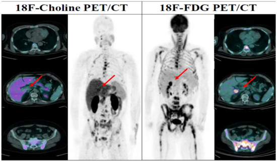 Beyond the Prognostic Value of 2-[18F]FDG PET/CT in Prostate Cancer: A ...