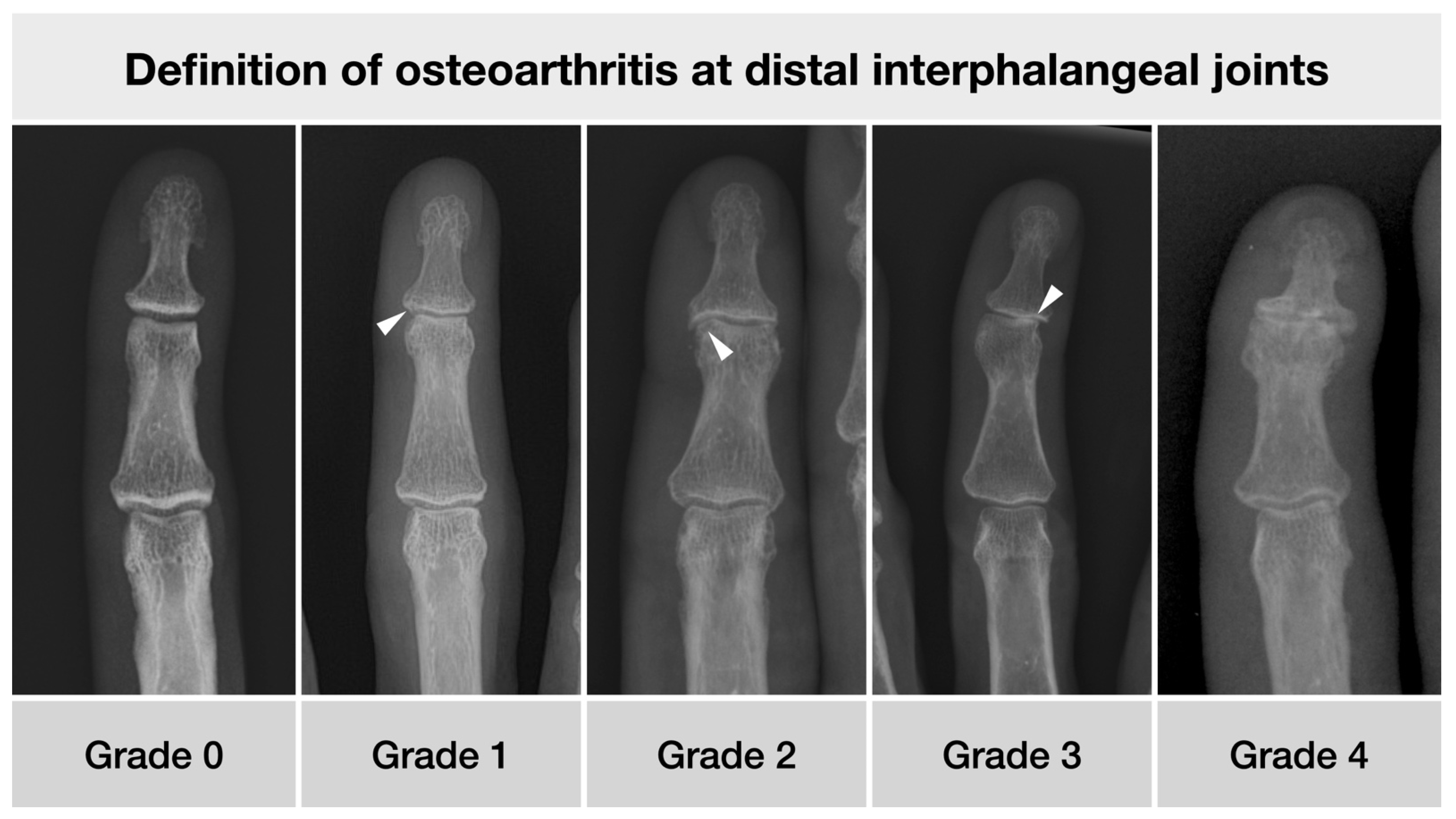 Diagnostics Free FullText OsteoProliferative Lesions of the Phalanges on Radiography