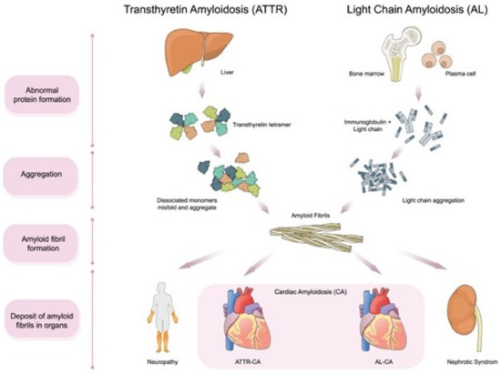 Global and Regional Variations in Transthyretin Cardiac
