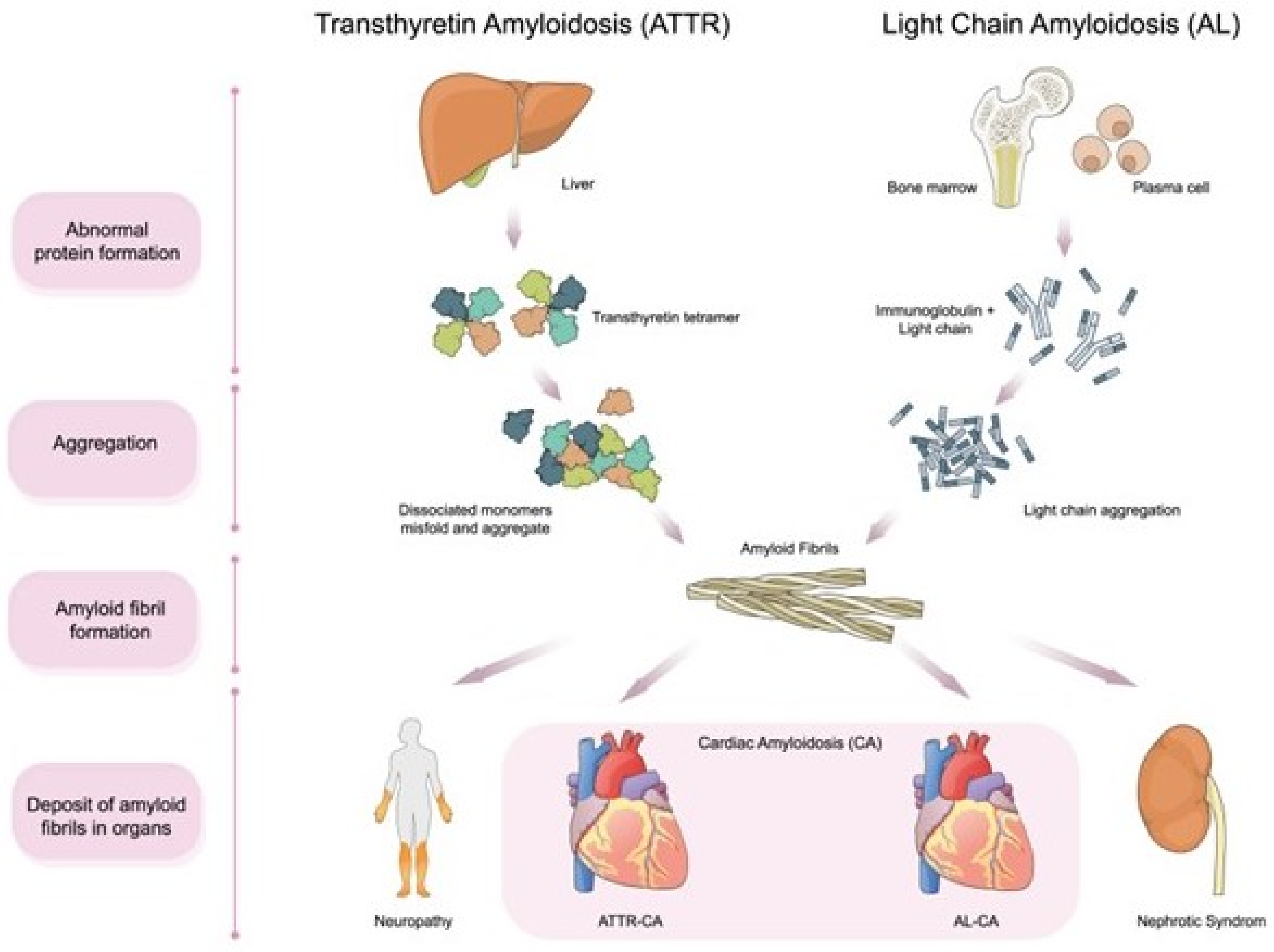 Prognostic value of right ventricular global longitudinal strain in  transthyretin amyloid cardiomyopathy - Journal of Cardiology