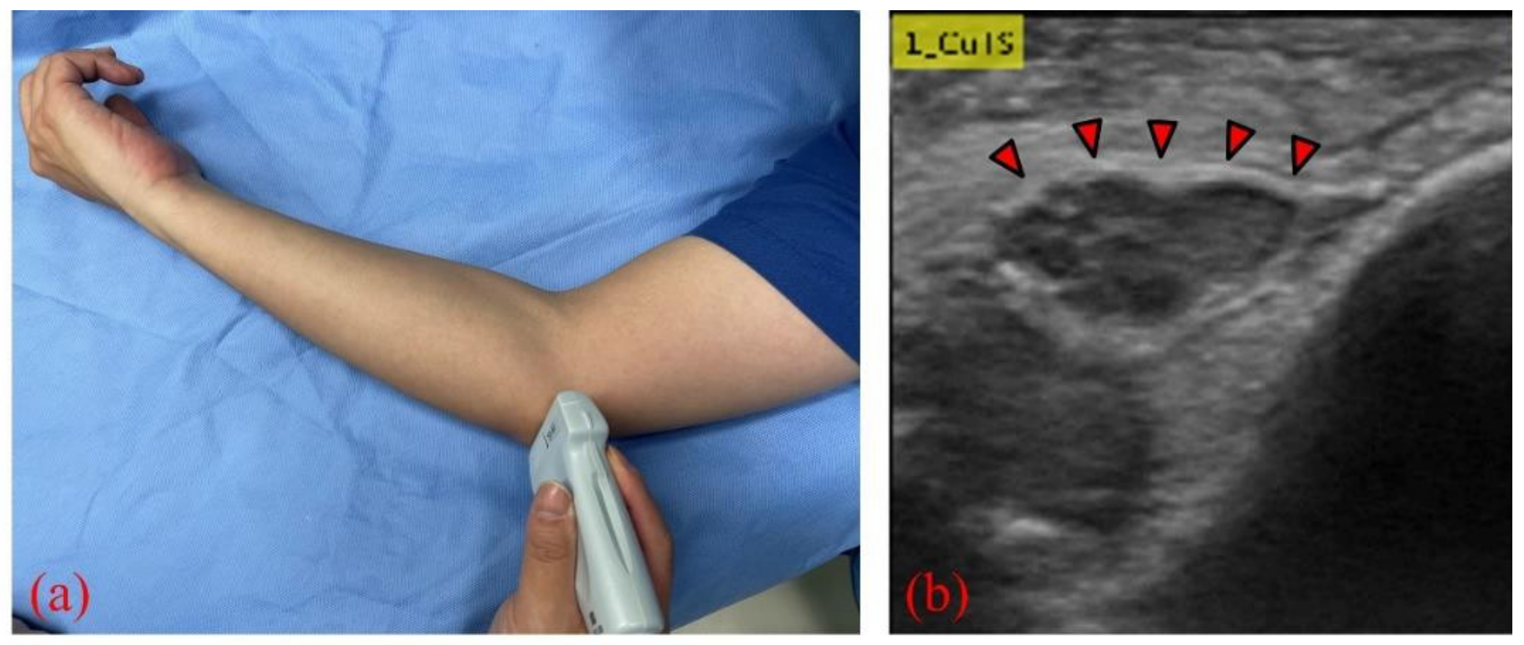 Diagnostics Free FullText Diagnosis of Cubital Tunnel Syndrome