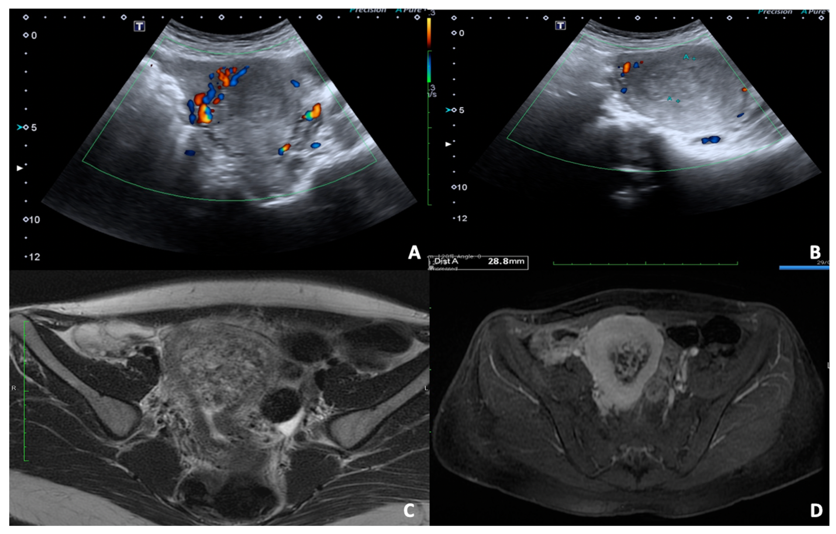 Hemoperitoneum from ruptured heterotopic pregnancy covering ovarian cyst