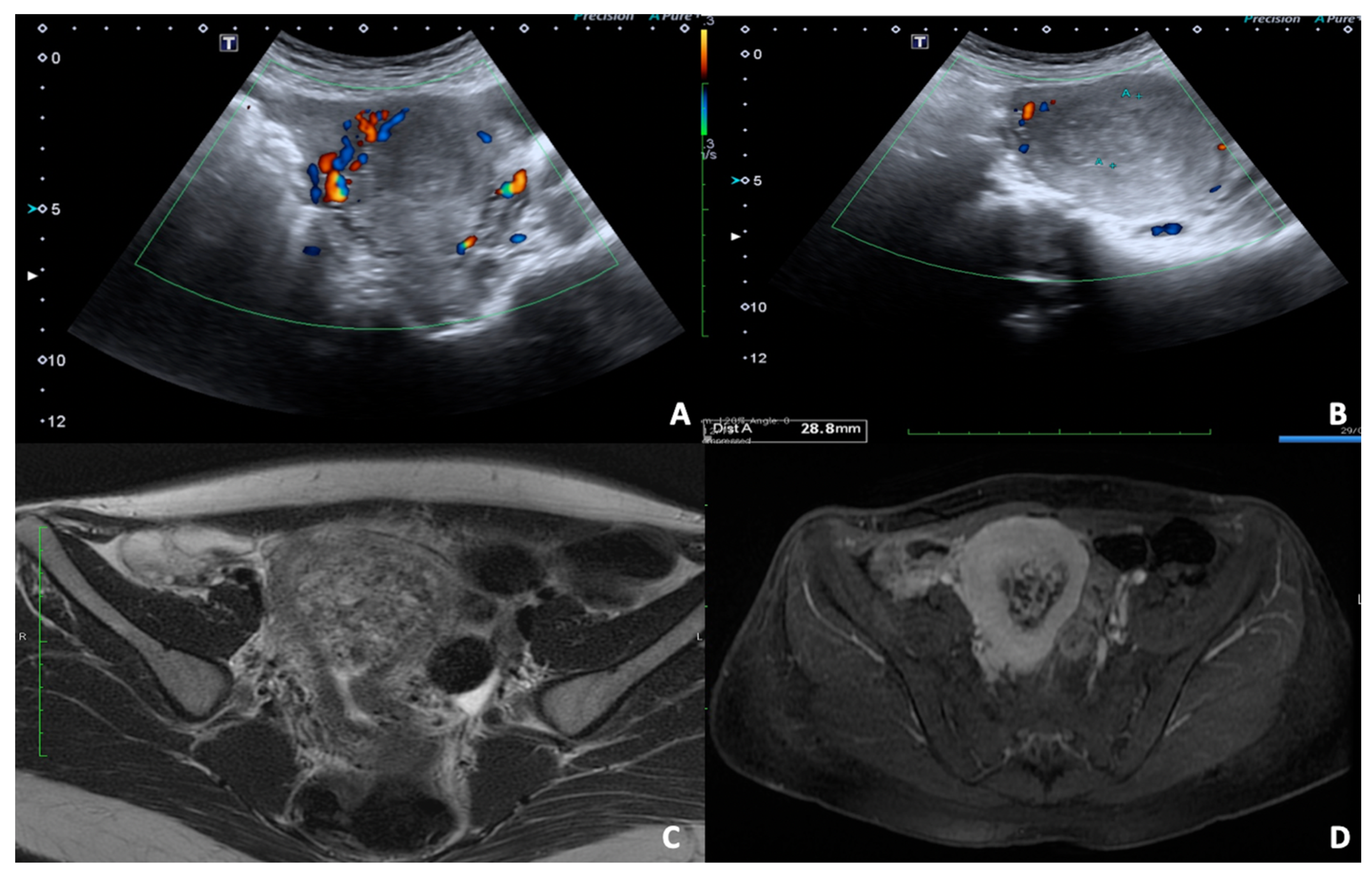 Obstetric and Gynecologic Emergencies in Cancer Patients | Oncohema Key