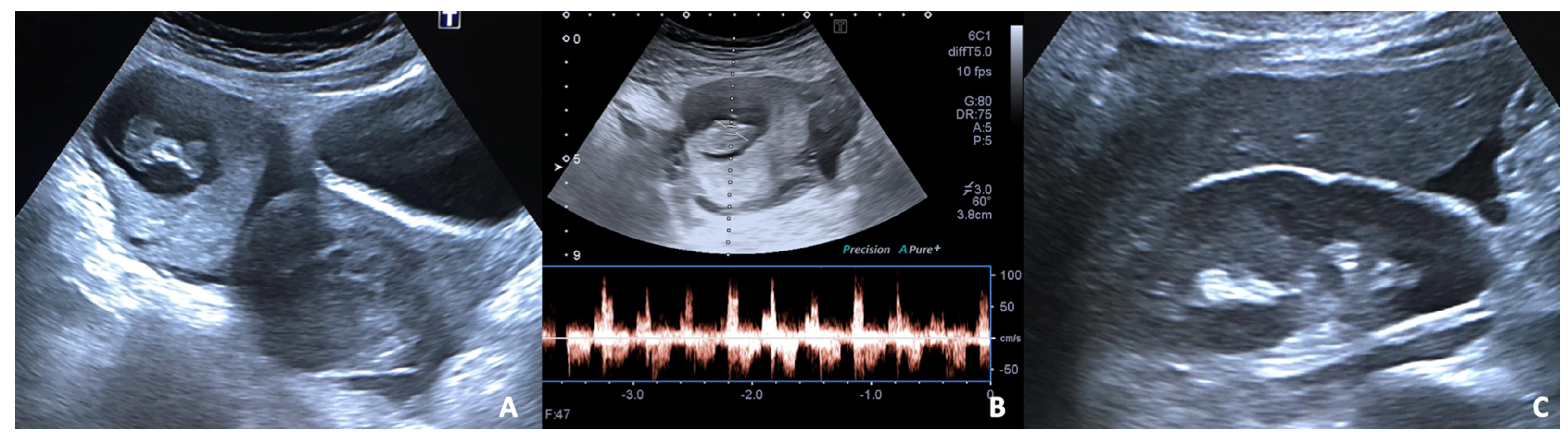 Figure 8 from TUBAL RING SIGN OF ECTOPIC PREGNANCY VERSUS CORPUS LUTEUM  CYST : BEST SONOGRAPHIC AND COLOR DUPLEX PREDICTORS | Semantic Scholar