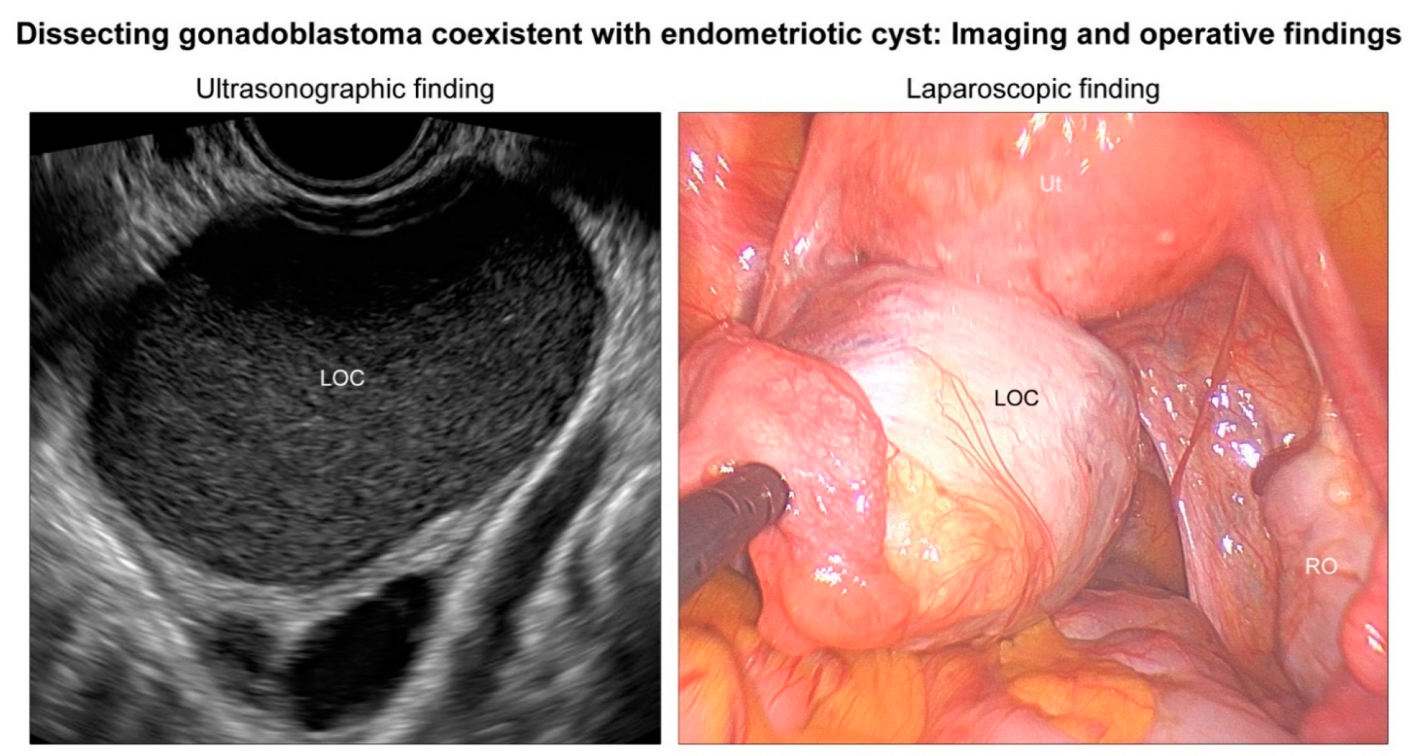 Diagnostics Free Full-Text Dissecting Gonadoblastoma of the Ovary Coexistent with an Atypical Endometriotic Cyst Incidental Detection in Cystectomy Specimen of a Woman with 46,XX Karyotype