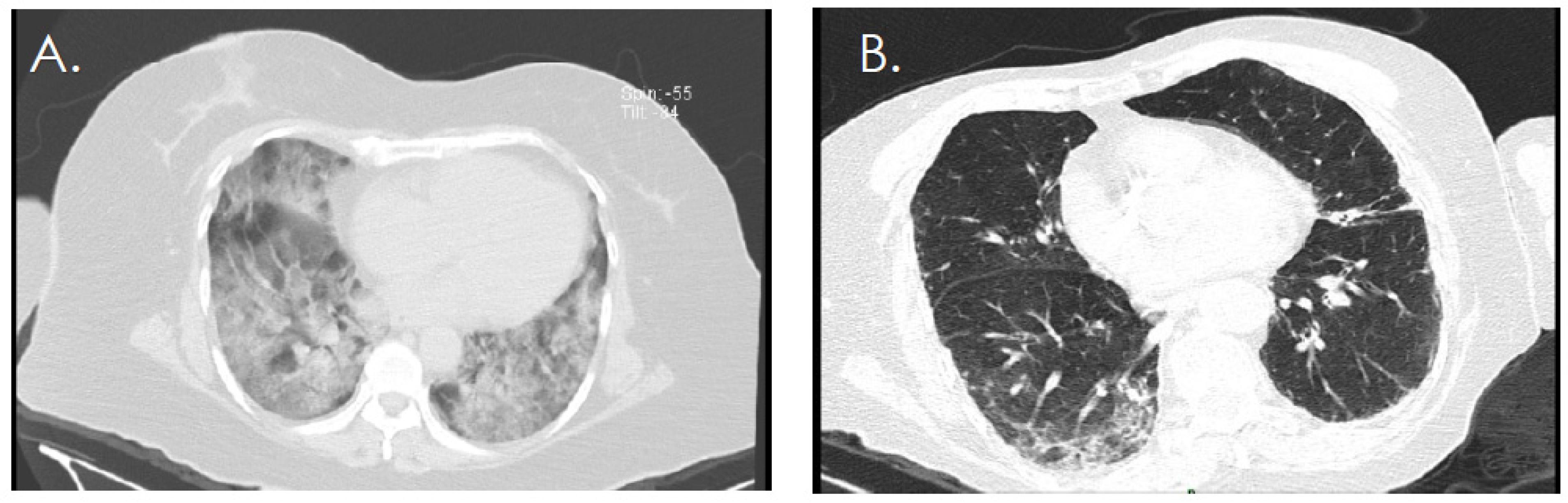 Diagnostics Free Full Text Radiological Findings Increased The Successful Of Covid 19 Diagnosis In Hospitalized Patients Suspected Of Respiratory Viral Infection But With A Negative First Sars Cov 2 Rt Pcr Result Html Diagnostics Free Full Text Radiological Findings Increased The Successful Of Covid 19 Diagnosis In Hospitalized Patients Suspected Of Respiratory Viral Infection But With A Negative First Sars Cov 2 Rt Pcr Result Html
