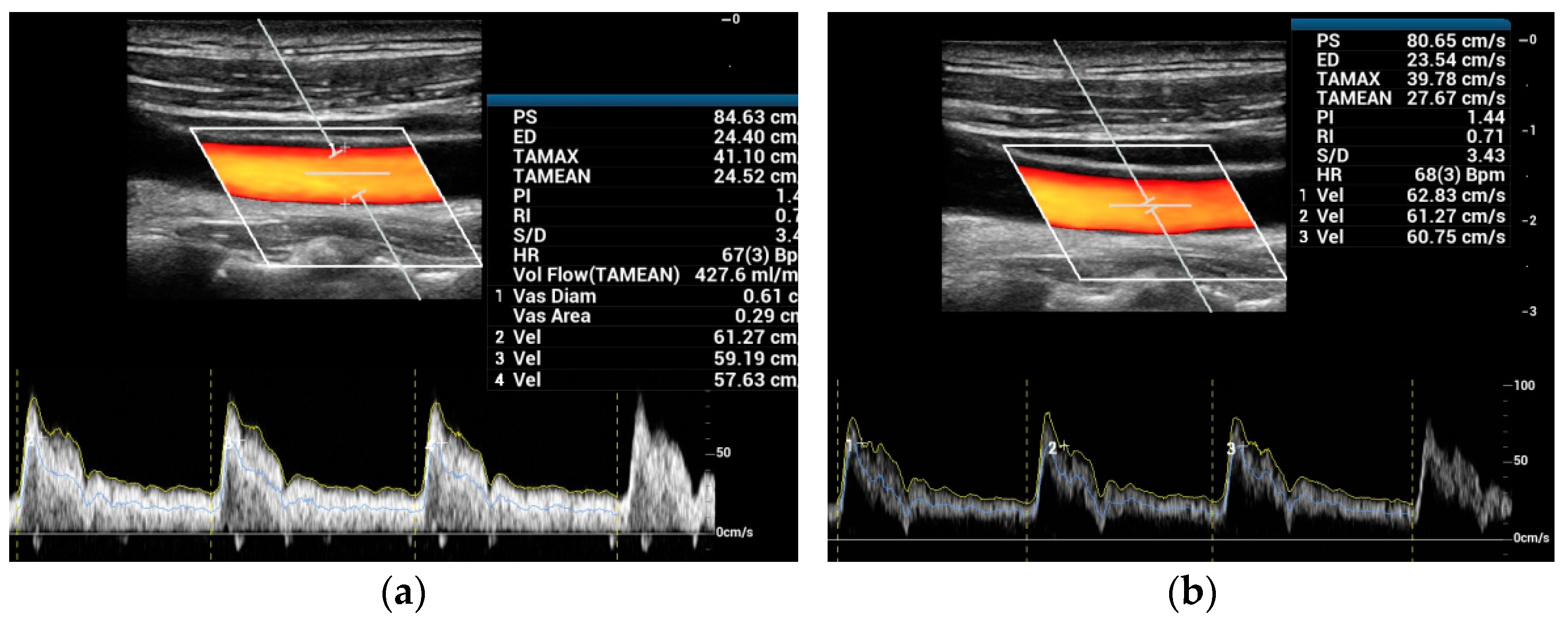 Quantitative Blood Flow Measurements in the Common Carotid Artery 