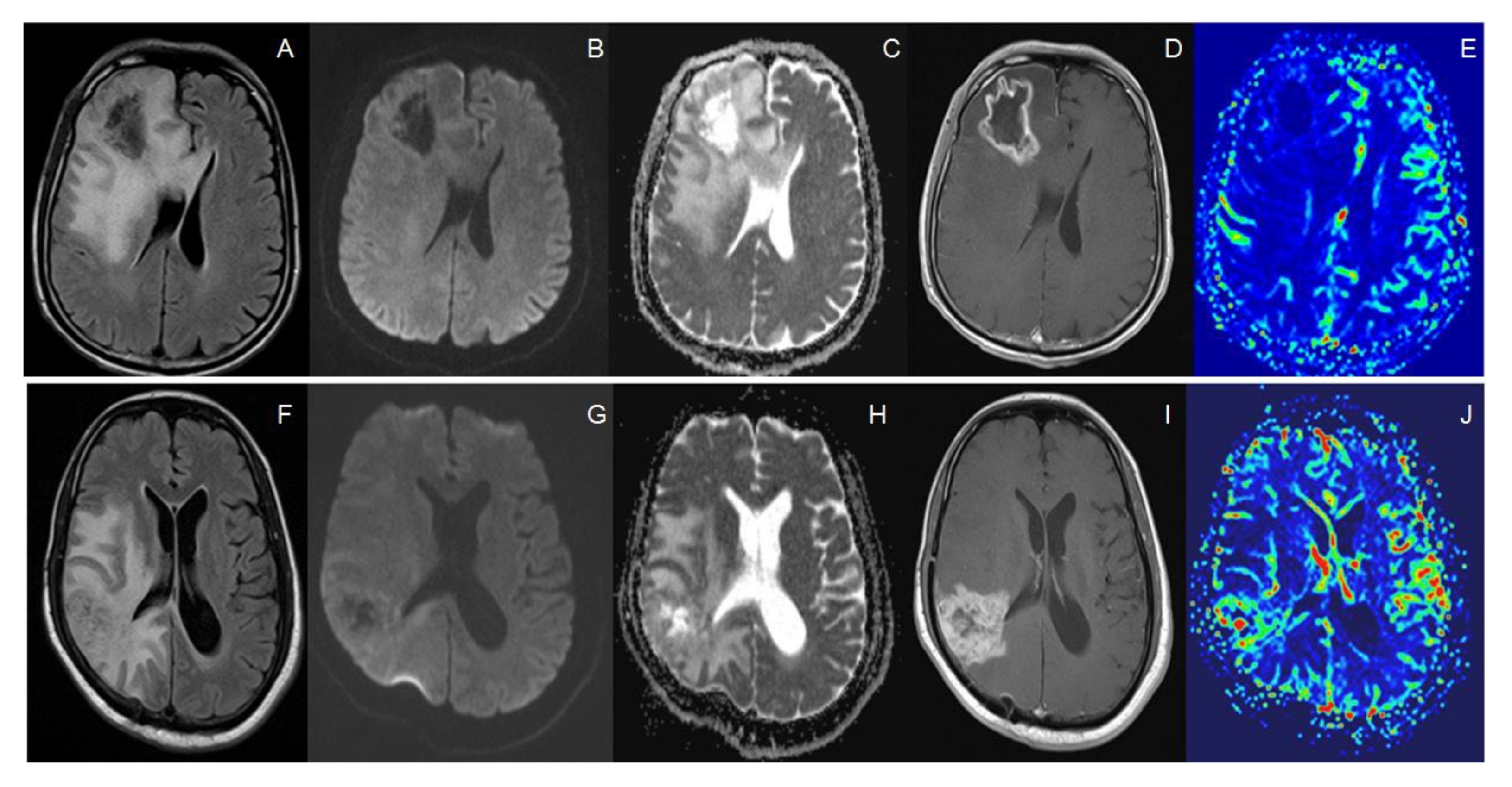 Diffusion and perfusion weighted magnetic resonance imaging