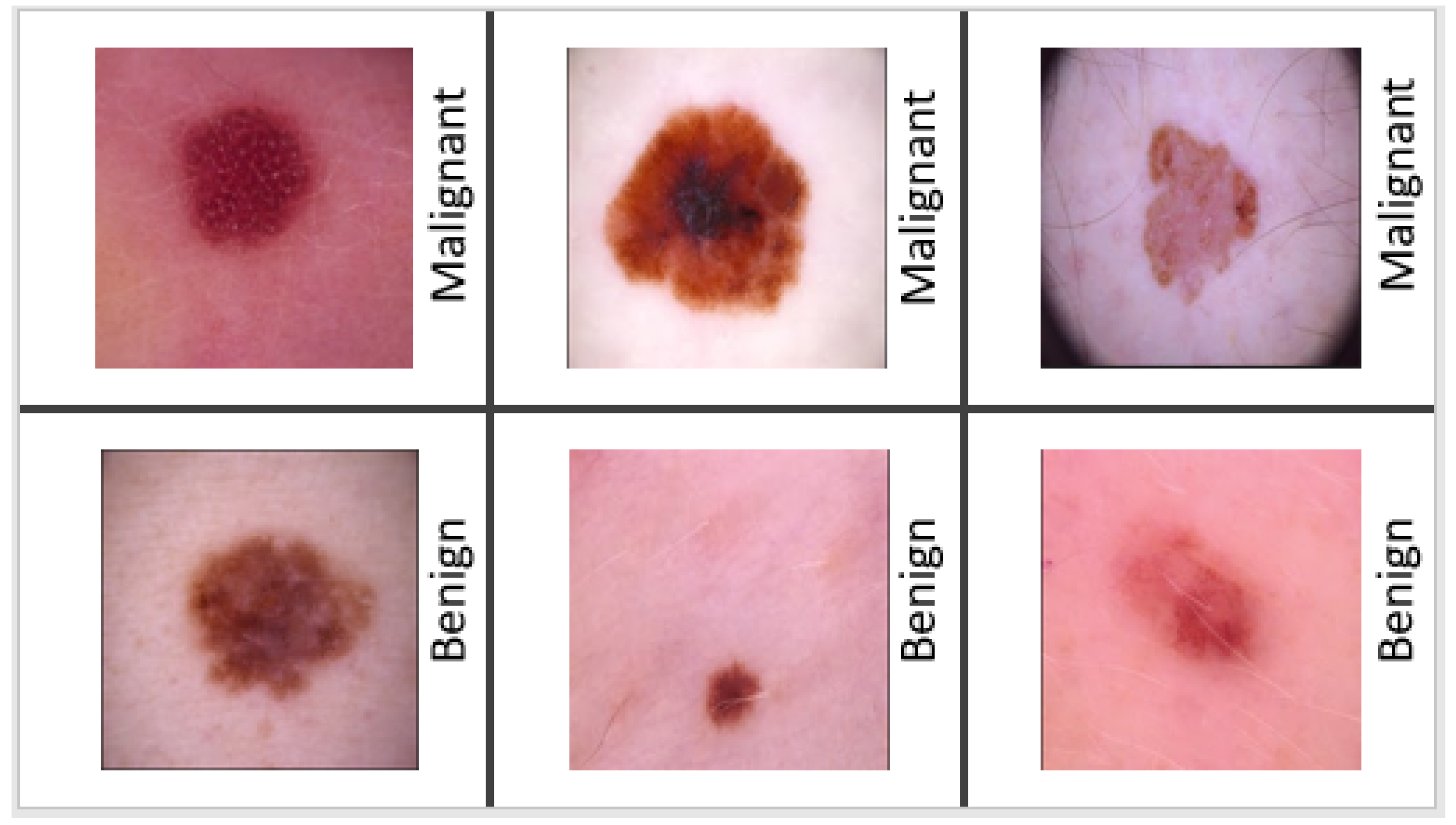 Malignant melanoma discount